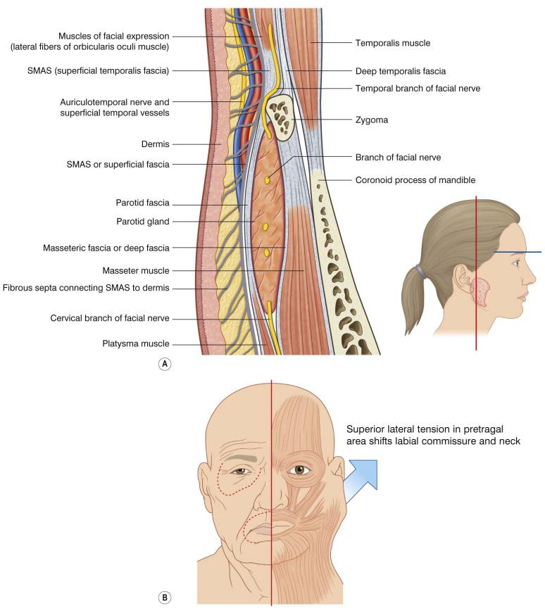 FIGURE 14.1, (A) Although the SMAS is a single connective tissue layer intricately connected to the muscles of facial expression, the scalp and forehead seem to be discontinuous with the lower face. The red pretragal line shows the location of the anatomic cross-section. The blue line at the level of the brow indicates this demarcation of the scalp and forehead from the lower face. (B) The labial commissure and anterolateral neck skin are mobilized and shifted by tension on the SMAS in the pretragal area below the zygomatic arch (the area indicated by the red line in A).