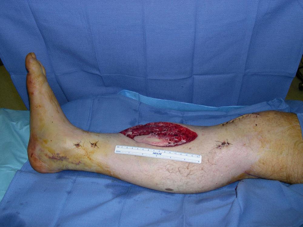 Fig. 47.1, A preoperative view showing an extensive middle tibia wound, measuring 13 × 6 cm, on the right leg with an exposed tibial fracture site and hardware.
