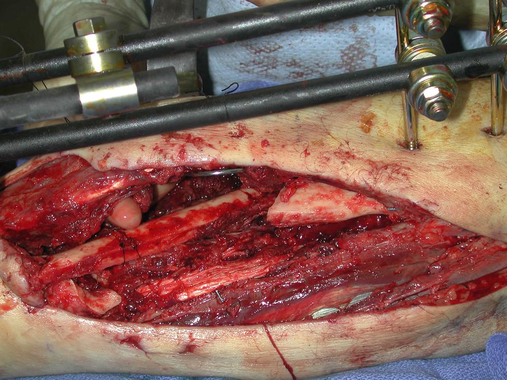 Fig. 47.14, An intraoperative view showing the pedicle fibular bone flap that could easily be transferred into the tibial bony defect of the right leg.