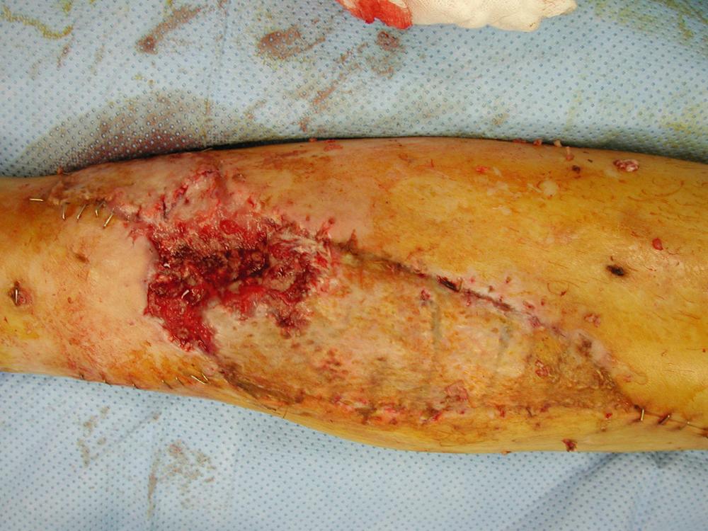 Fig. 47.18, Results at 3 weeks postoperative showing distal tip necrosis of the medial hemisoleus muscle flap.