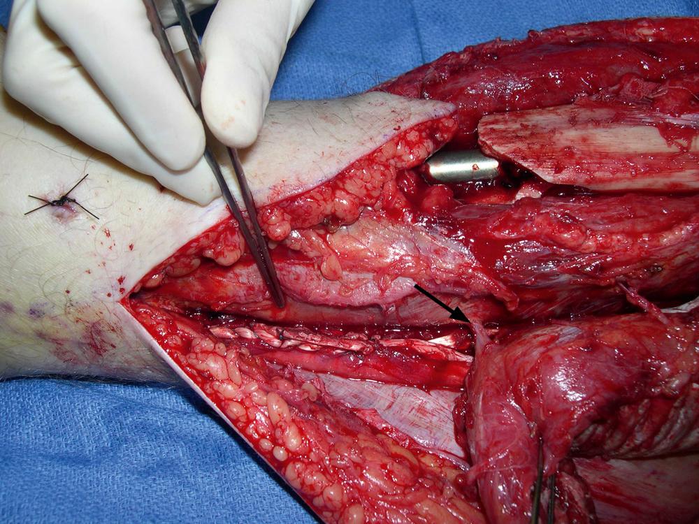 Fig. 47.5, An intraoperative view showing the preserved perforator from the posterior tibial vessels to the medial hemisoleus muscle flap ( arrow ). The left intact conjoint tendon from the distal medial half of the soleus muscle is approximated to the remaining lateral half of the soleus muscle with nonabsorbable sutures (indicated by forceps ) after the flap dissection has been completed.