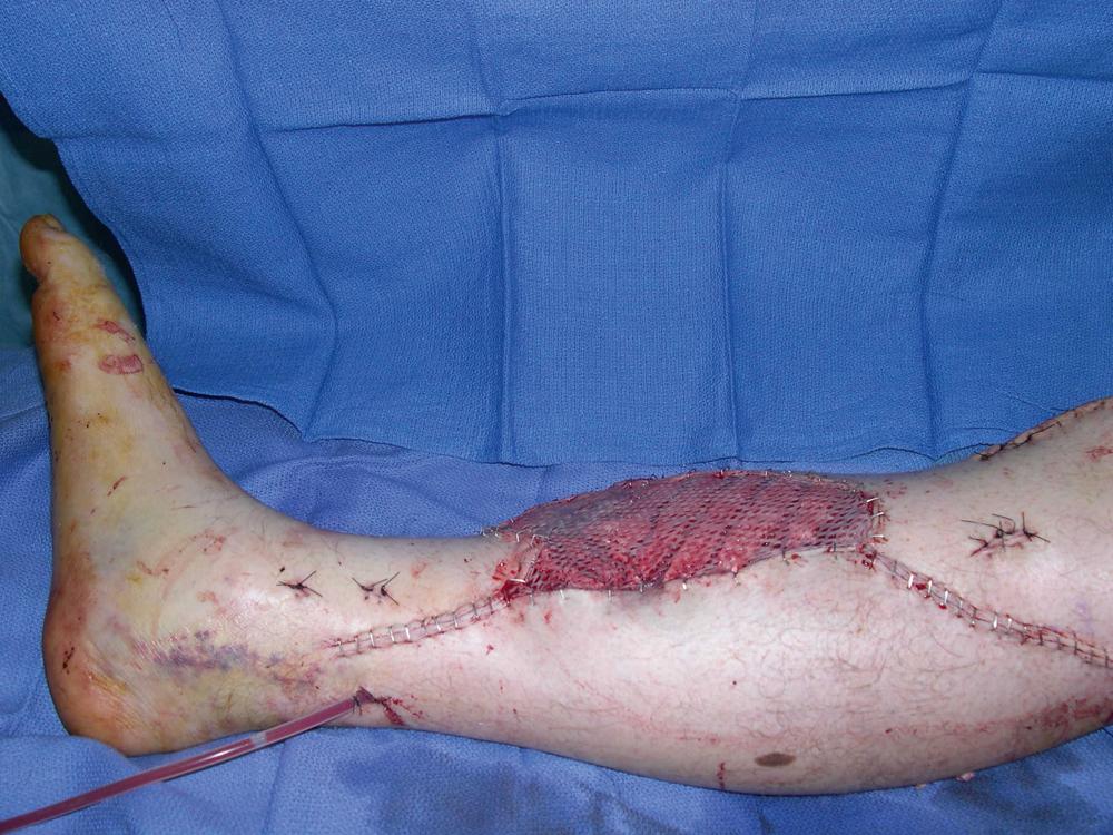 Fig. 47.7, An intraoperative view showing completion of a skin graft placement over both muscle flaps.