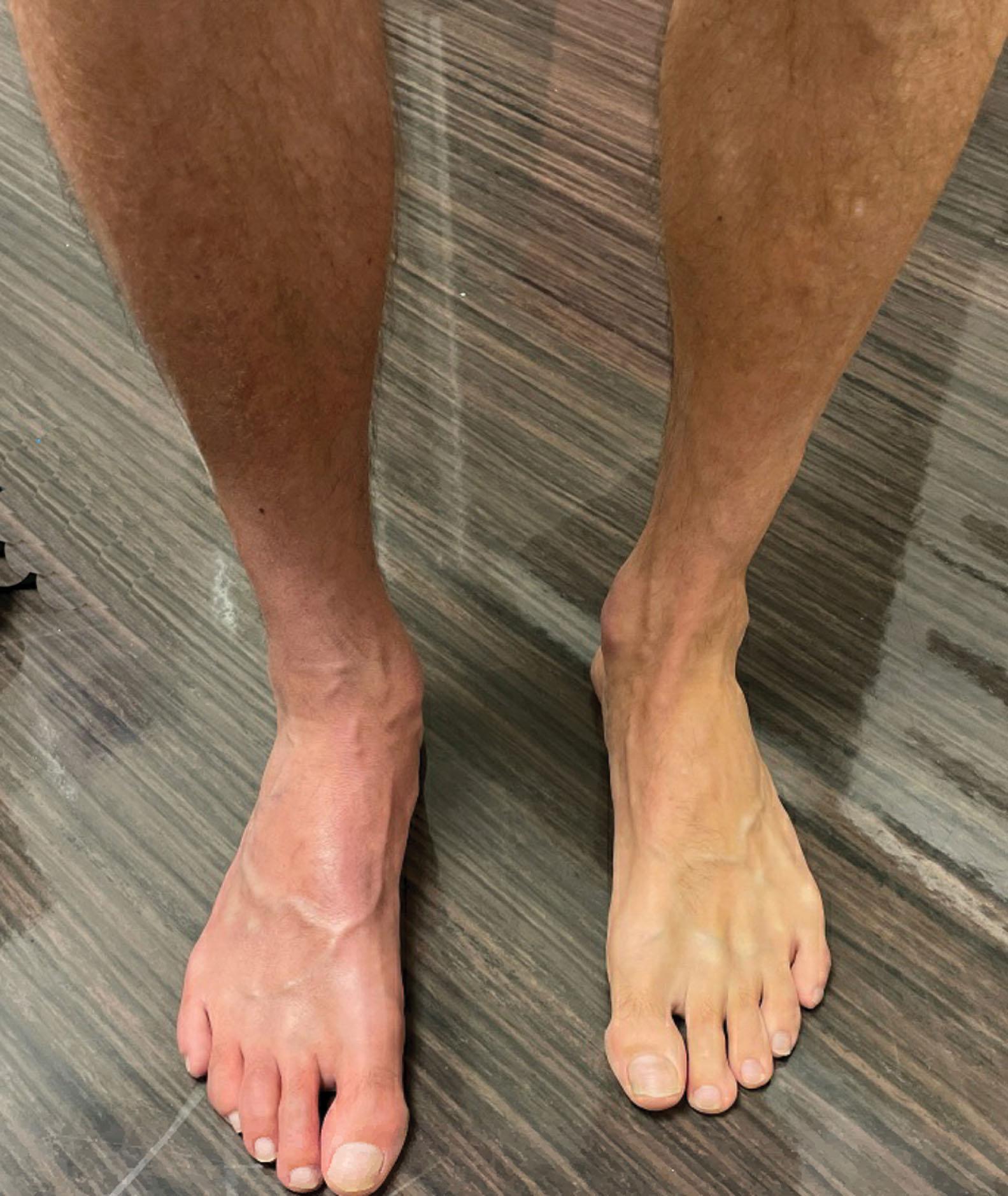 Fig. 20-1, Photograph of a 35-year-old man with classic signs of complex regional pain syndrome including swelling, redness, joint stiffness, and temperature change 8 weeks after sustaining a calf contusion playing soccer.