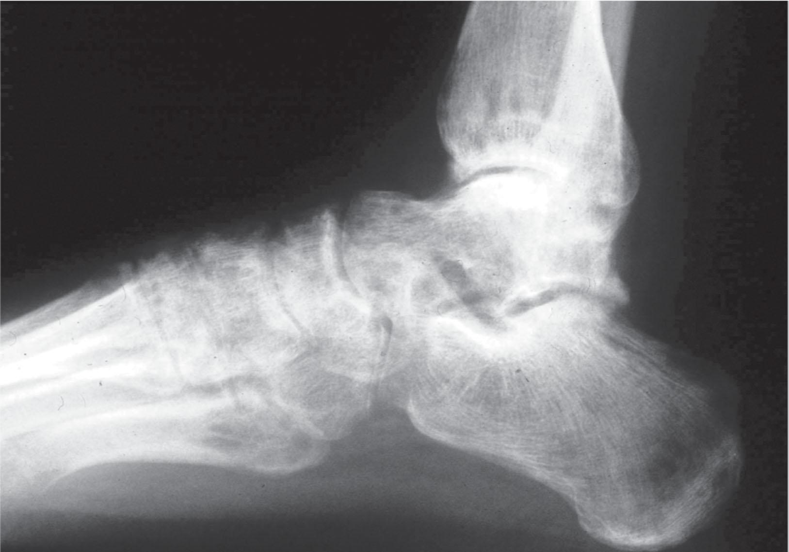 Fig. 20-2, Severe osteoporosis in a lateral radiograph of a 42-year-old man with complex regional pain syndrome for 6 months.