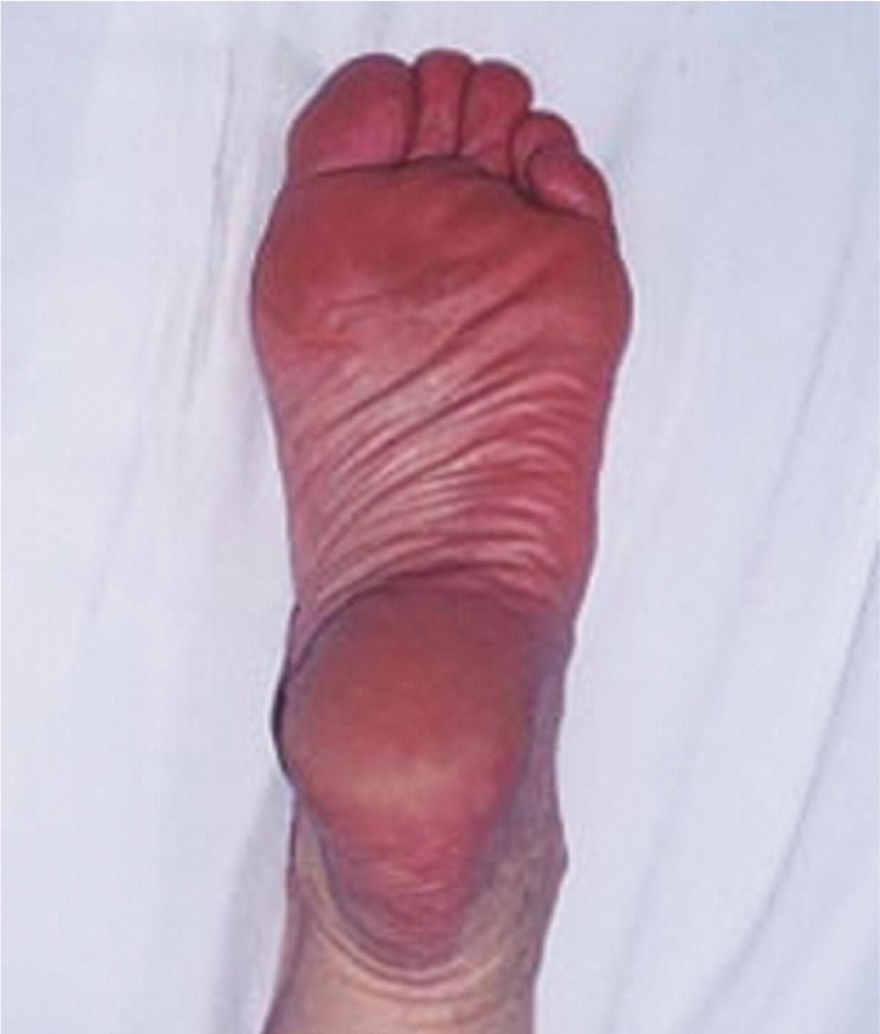 Fig. 20-4, Erythromelalgia during a flare-up.