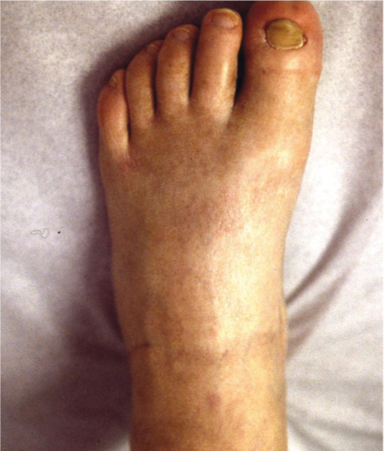 Fig. 20-5, Early complex regional pain syndrome showing shiny skin.