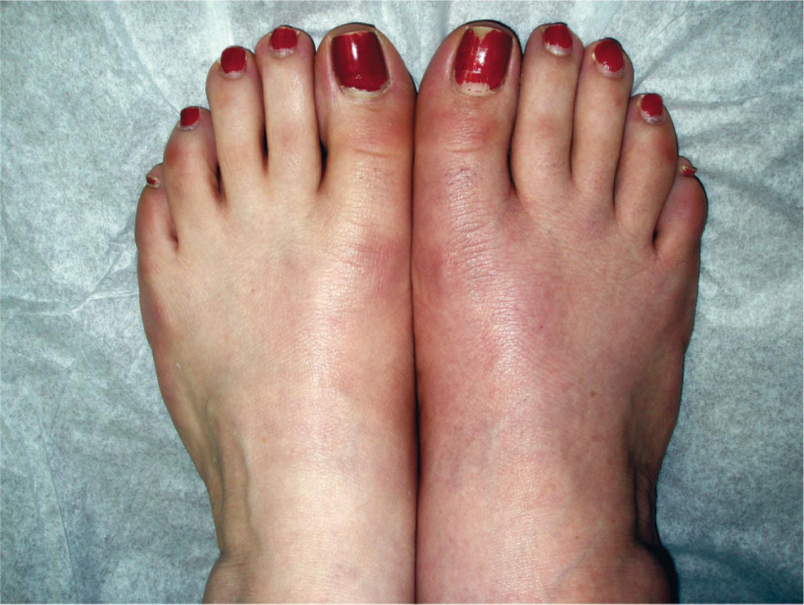 Fig. 20-6, Early complex regional pain syndrome in the left foot.