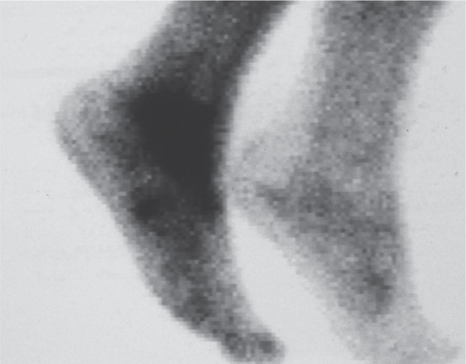 Fig. 20-7, Positive bone scan in complex regional pain syndrome.