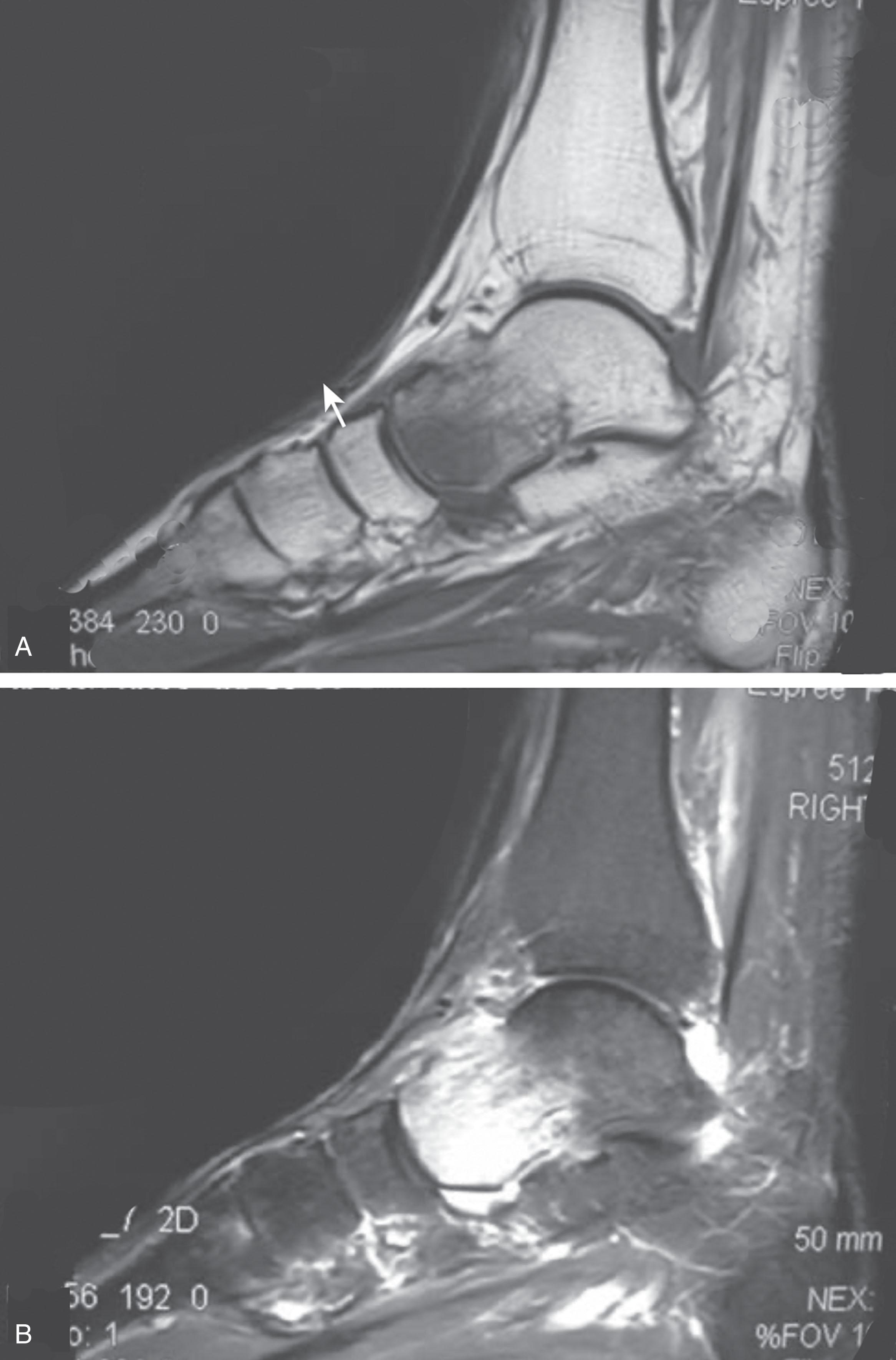 Fig. 20-8, A and B , Underlying talar contusion on magnetic resonance image rules out complex regional pain syndrome.