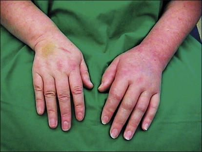 Figure 67-1, Clinical picture of a patient with complex regional pain syndrome type 1 of the upper left extremity following distortion of the left wrist.