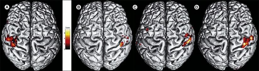 Figure 67-2, Central reorganization of the somatosensory cortex in a patient with complex regional pain syndrome type 1 involving the right hand.