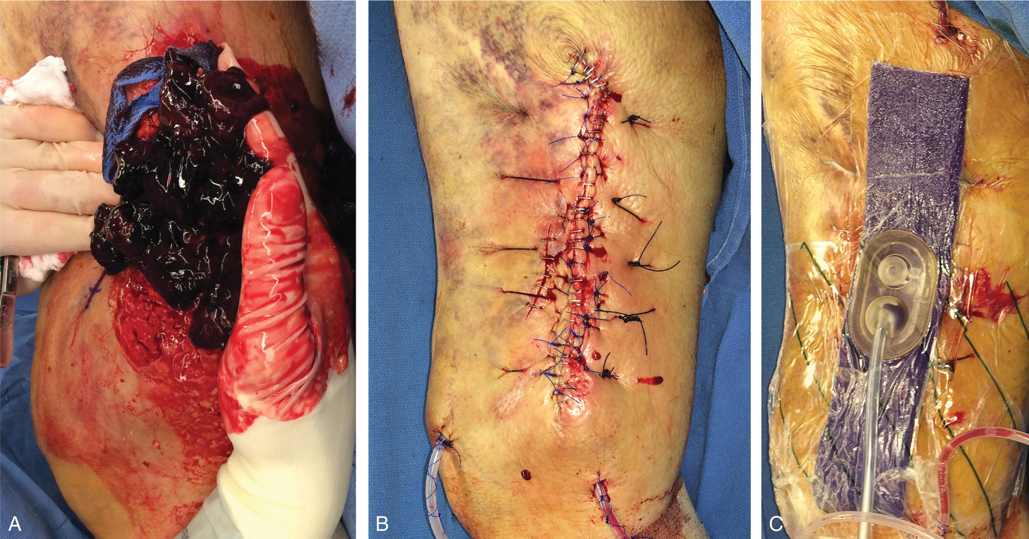 Fig. 42-1, A , Massive traumatic hematoma. B , Closure is performed with deep progressive sutures to decrease “dead space,” followed by deep dermal sutures and multiple retention suture closure over deep drains. C , Incisional negative pressure wound dressing to “splint” wound edges and facilitate.