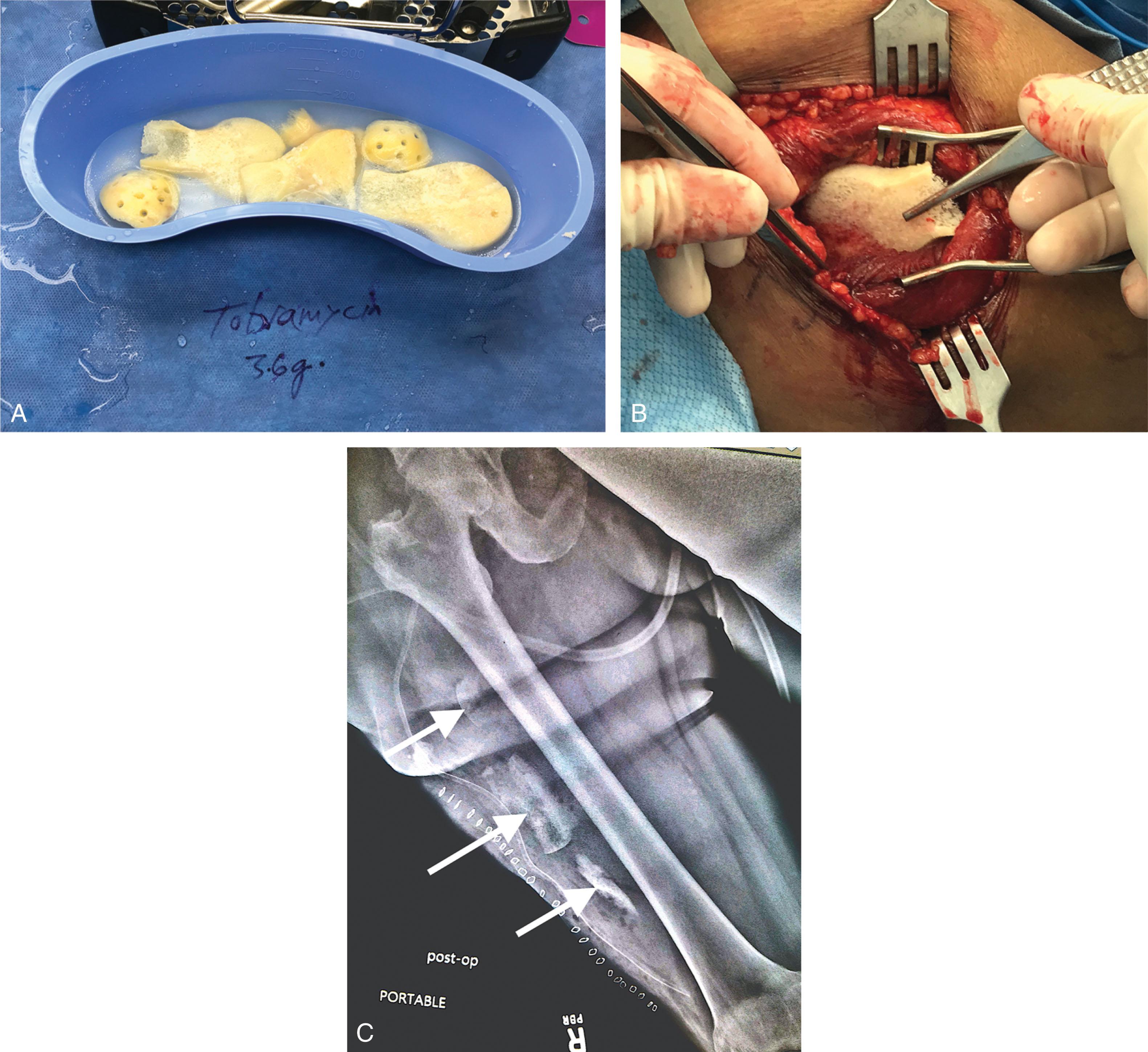 Fig. 42-11, A , Femoral head allograft prepared for implantation during bone banking procedure. B , Implantation of (A) into vastus lateralis. C , Radiograph of banked bone in situ (arrows).