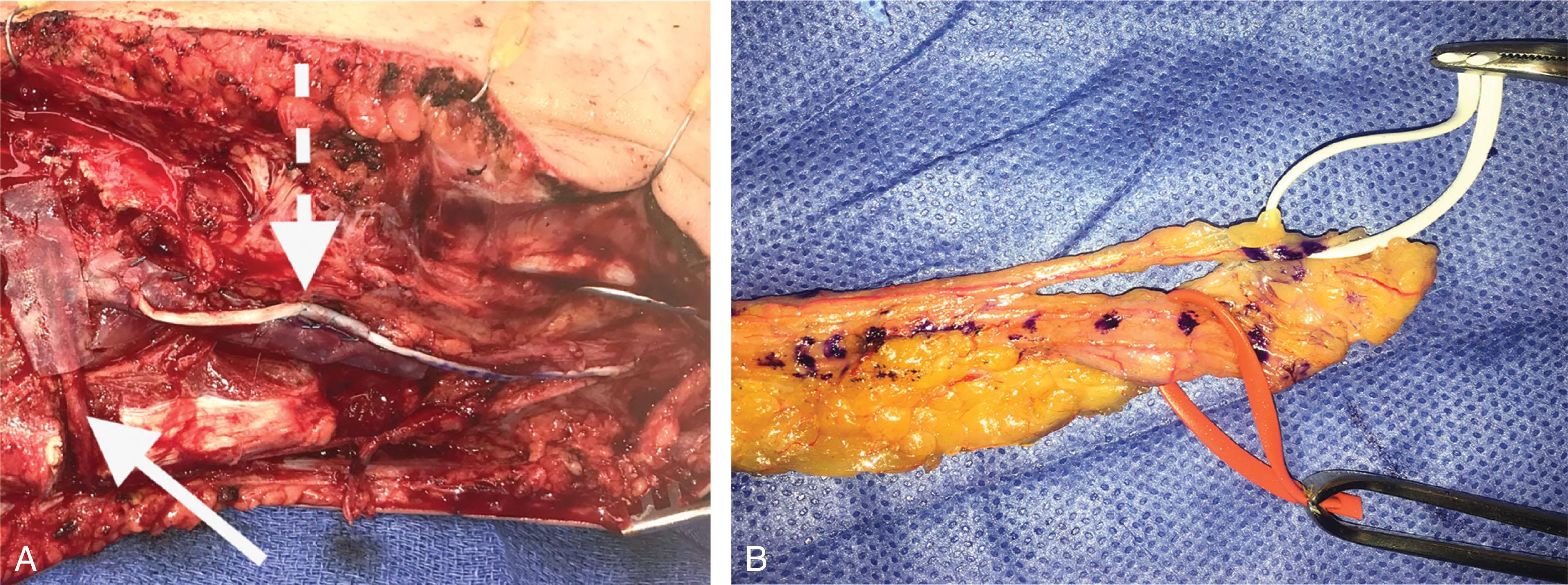 Fig. 42-12, A , Intra-operative photograph of nerve transfer (solid arrow) and allograft nerve “jump graft” (dashed arrow). B , Composite tissue harvest for reverse flow through vascularized saphenous nerve free flap. Greater saphenous vein (red vessel loop) will be reversed (arterialized) and micro-anastomosed to the recipient artery; the saphenous nerve (white vessel loop) is micro-anastomosed to span the recipient nerve intercalary defect. The nerve free flap may also be used in a “jump graft” fashion.