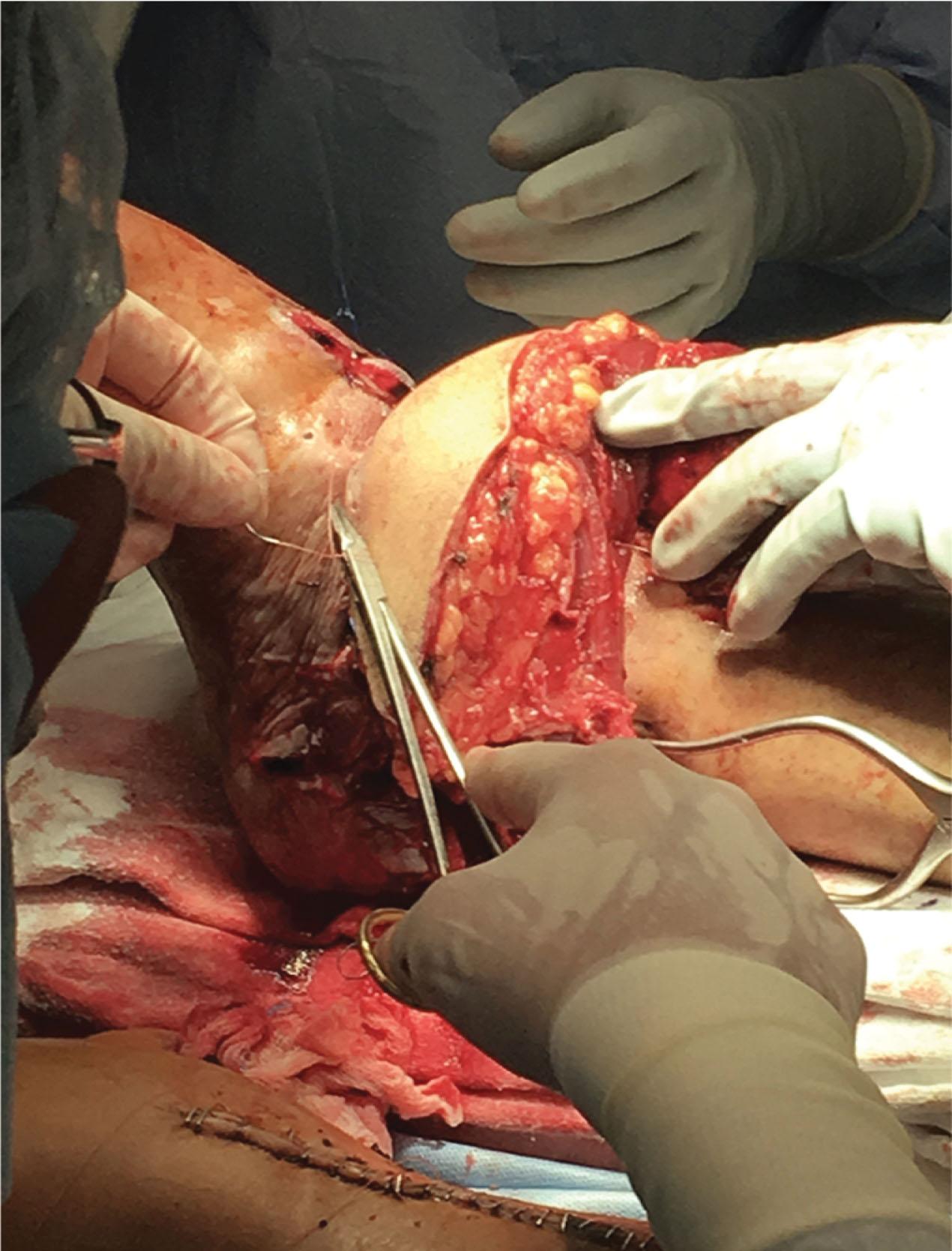 Fig. 42-13, Emergency rectus abdominus myocutaneous free flap (VRAM free flap) to protect bypass and cover large defect during foot re-planation. The VRAM was chosen for the rapid harvest, donor-recipient vessel diameter match and adequate vascular pedicle length.