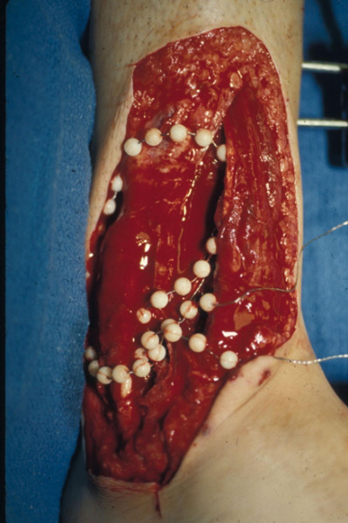 Fig. 42-14, Antibiotic beads placed within an ankle wound.