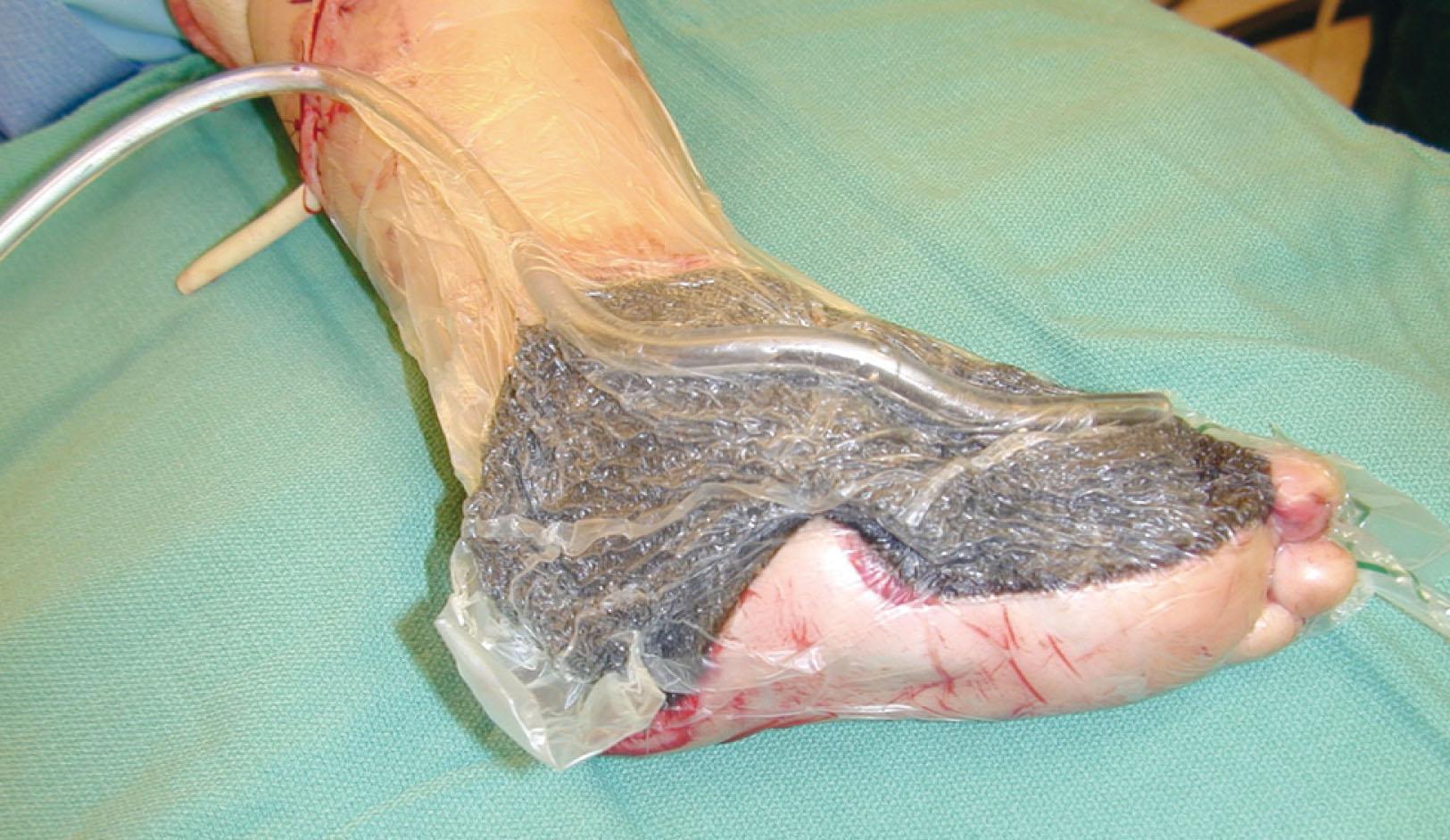 Fig. 42-15, Vacuum-assisted closure was used for this traumatic foot wound before definitive coverage with a free latissimus myocutaneous transfer.