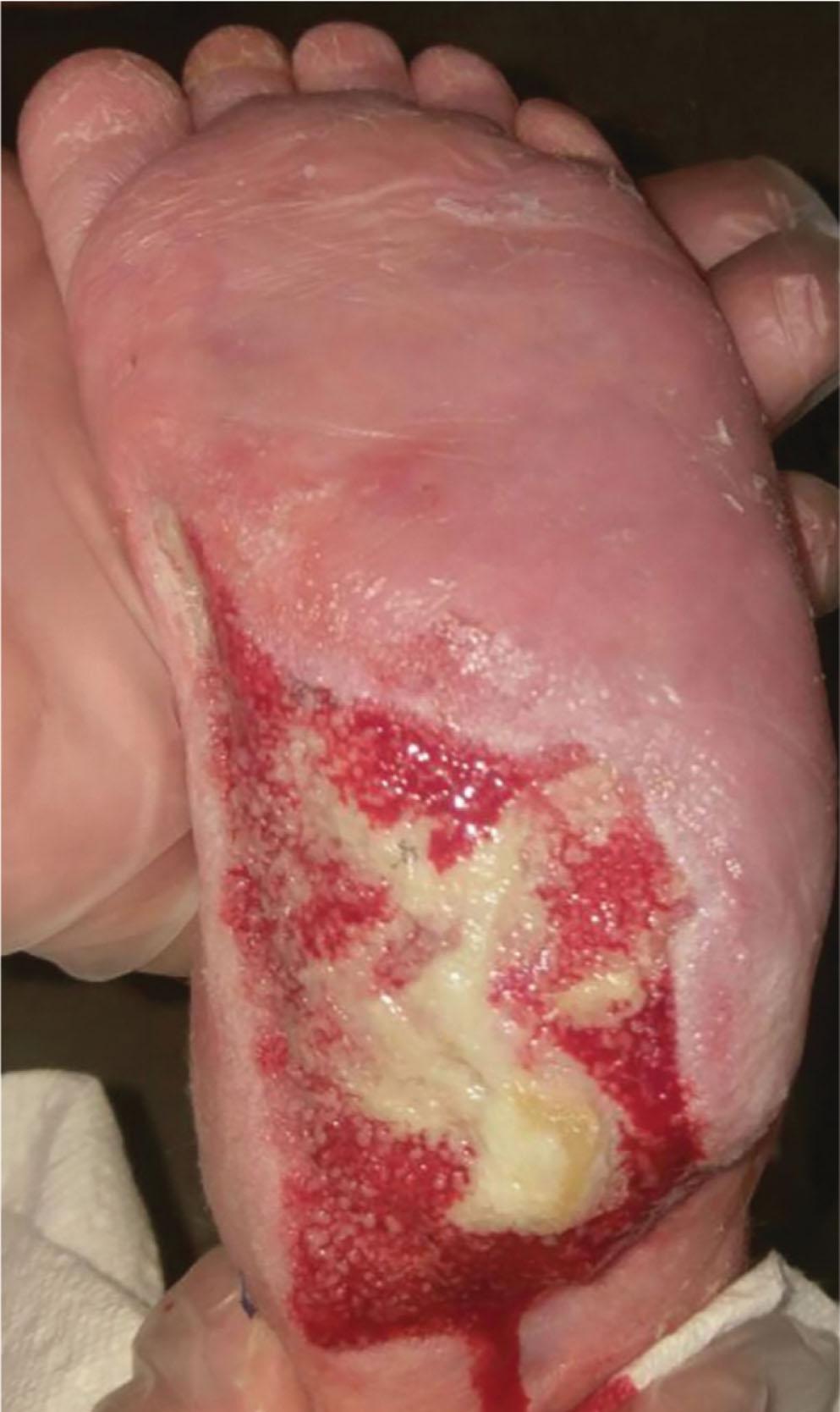 Fig. 42-2, Example of an unstable granulation bed over the heel of a child. Multiple weeks of negative pressure dressings failed to provide a satisfactory wound bed and was complicated by repeat bouts of cellulitis. This patient underwent a reverse sural flap.