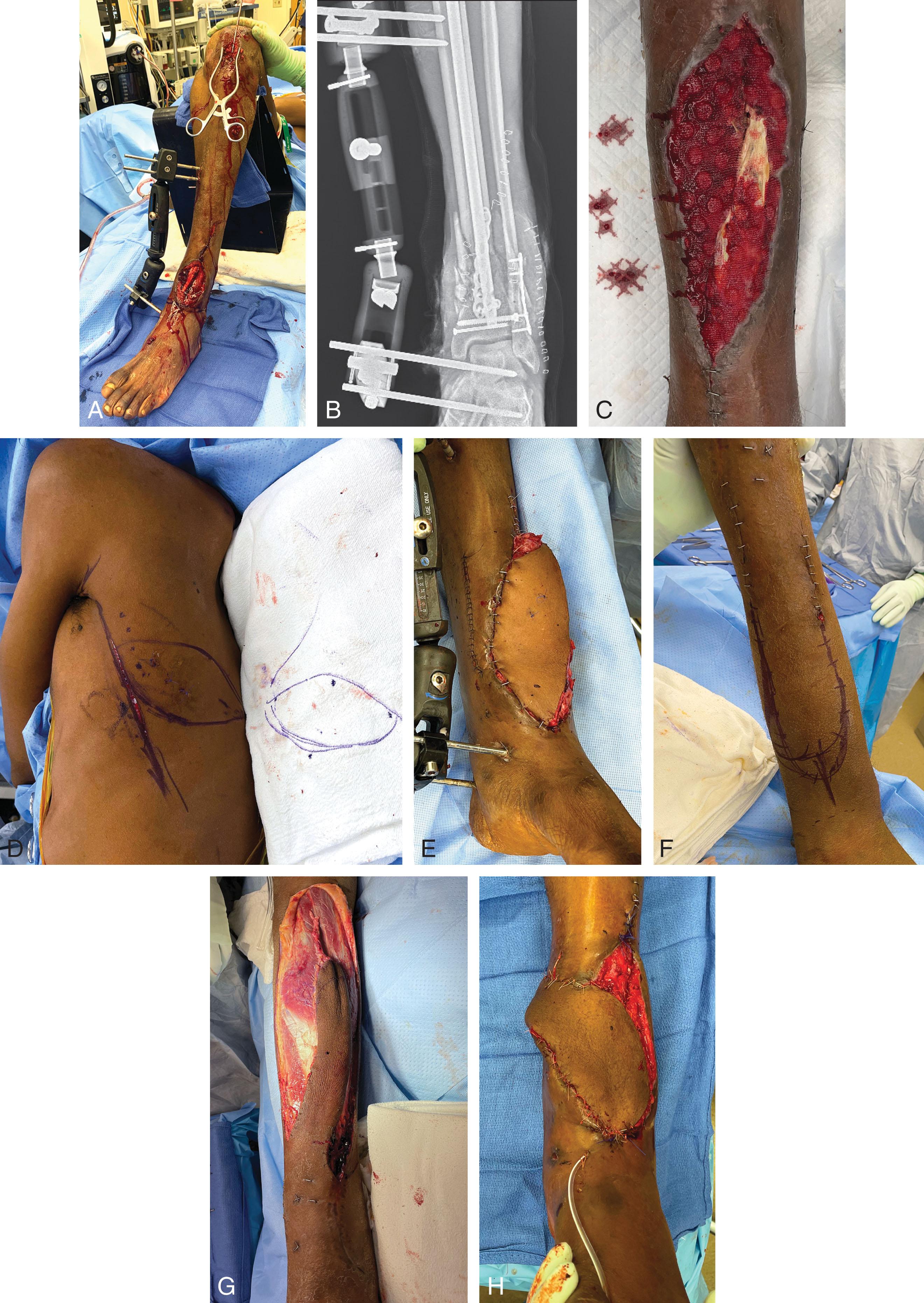 Fig. 42-3, A , High velocity gunshot wound (GSW) to distal tibia/ankle with transection of major vessels and pilon fracture. External fixation was performed to stabilize the bone, followed by microvascular repair. To minimize any further soft tissue stripping, external fixator-assisted intramedullary nailing and limited internal fixation was performed. B , Radiograph of procedure. C , The patient sustained multiple abdominal GSWs and subsequently developed repeat intra-abdominal abscess and remained unstable in the intensive care unit for a prolonged period of time. An inflow/outflow negative pressure wound dressing (Veraflo; 3M, Saint Paul, MN) provided wound protection but only superficial granulation (a deep open space remained with exposed bone). D , When cleared for the operating room, soft tissue coverage was performed with a latissimus myocutaneous free flap. E , Inset of the latissimus myocutaneous free flap, microanastomosed to the tibialis anterior artery and vein. Despite performing the anastomosis far away from the zone of injury (proximal one third of the leg), recurrent intra-abdominal sepsis with prolonged hypotension resulted in death of the free flap. F , After weeks, the patient again was stable. A reverse sural flap was performed, elevated in a delayed (staged) fashion, minimizing operative time (versus a revision free flap). G , Complete elevation of the reverse sural flap. H , Final inset of the reverse sural flap, which went on to heal.