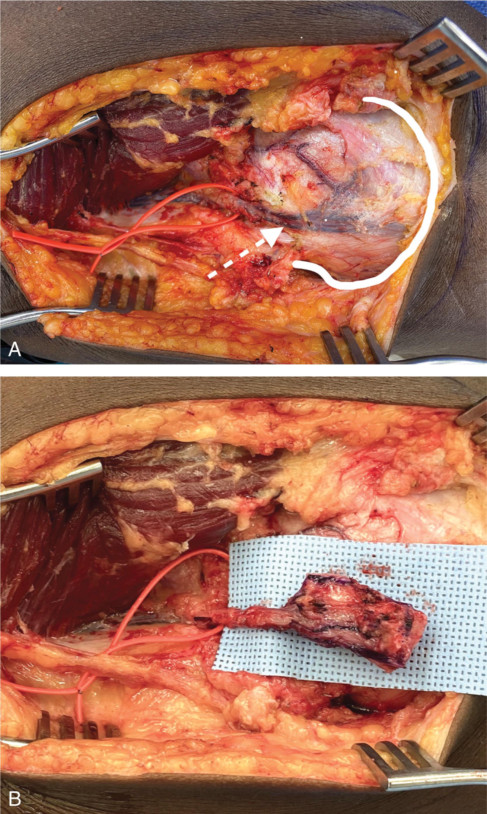 Fig. 42-4, A , The descending medial geniculate artery and vein pedicle of the medial femoral condyle free flap. The medial geniculate vessels (red vessel loop) continue onto the surface of the medial femoral condyle (solid white outline). Note the robust arborization onto the periosteum. B , Harvest of the medial femoral condyle (medial geniculate artery) free flap. A vascularized bone free flap may be customized in length up to the length of the femoral condyle; the width may be up to 4 cm, and the graft depth generally does not exceed 2 cm; grafts larger than this may require internal fixation of the donor site. Back-fill of the donor site may be performed with calcium-based bone void fillers. It is also possible to include articular cartilage with the free flap, which is harvested from the edge of femoral condyle, being situated off the weight-bearing portion the articular surface. The author also utilizes just the periosteum as a free flap.