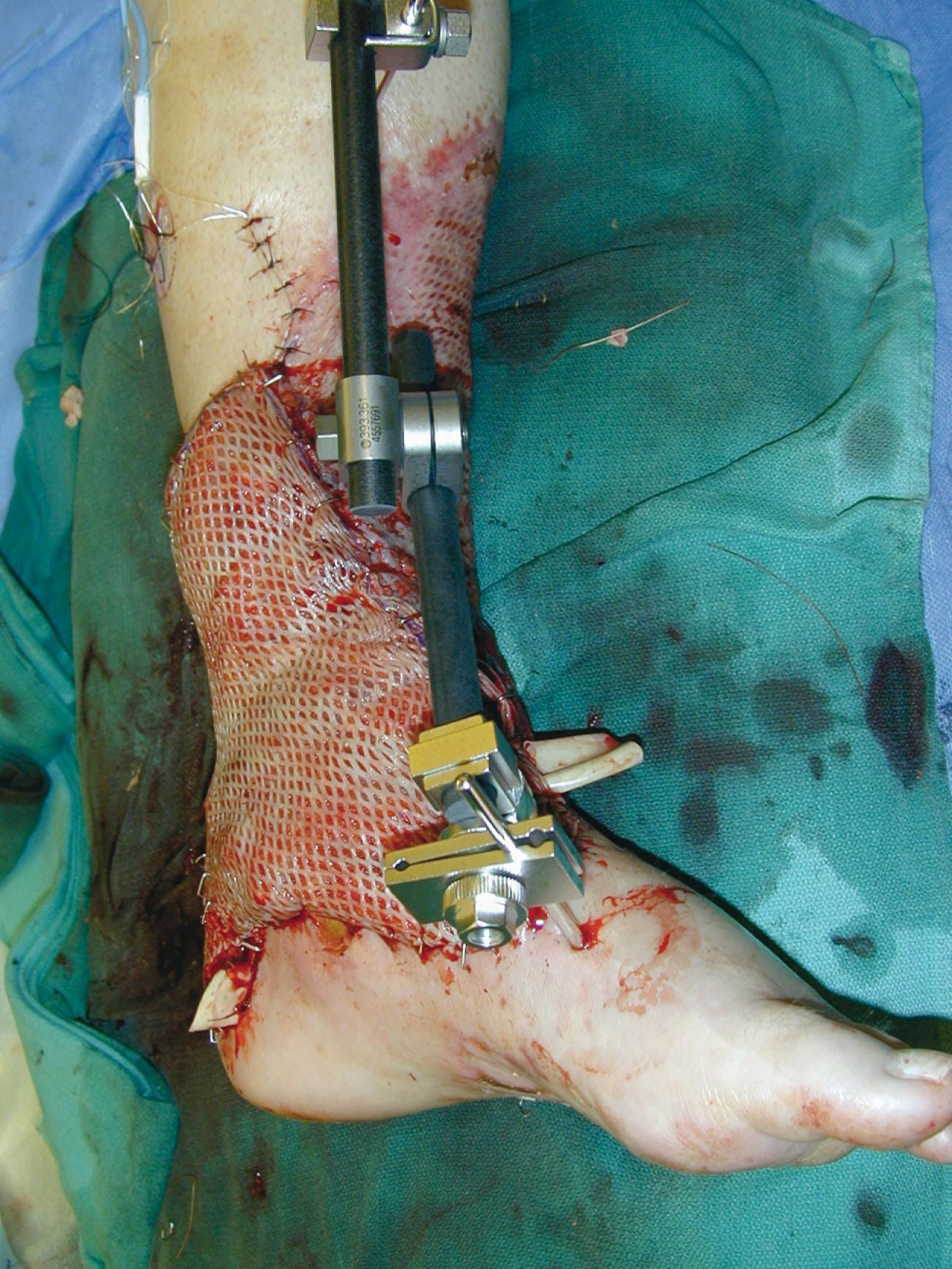 Fig. 42-5, A meshed split-thickness skin graft applied over a free latissimus myocutaneous transfer.