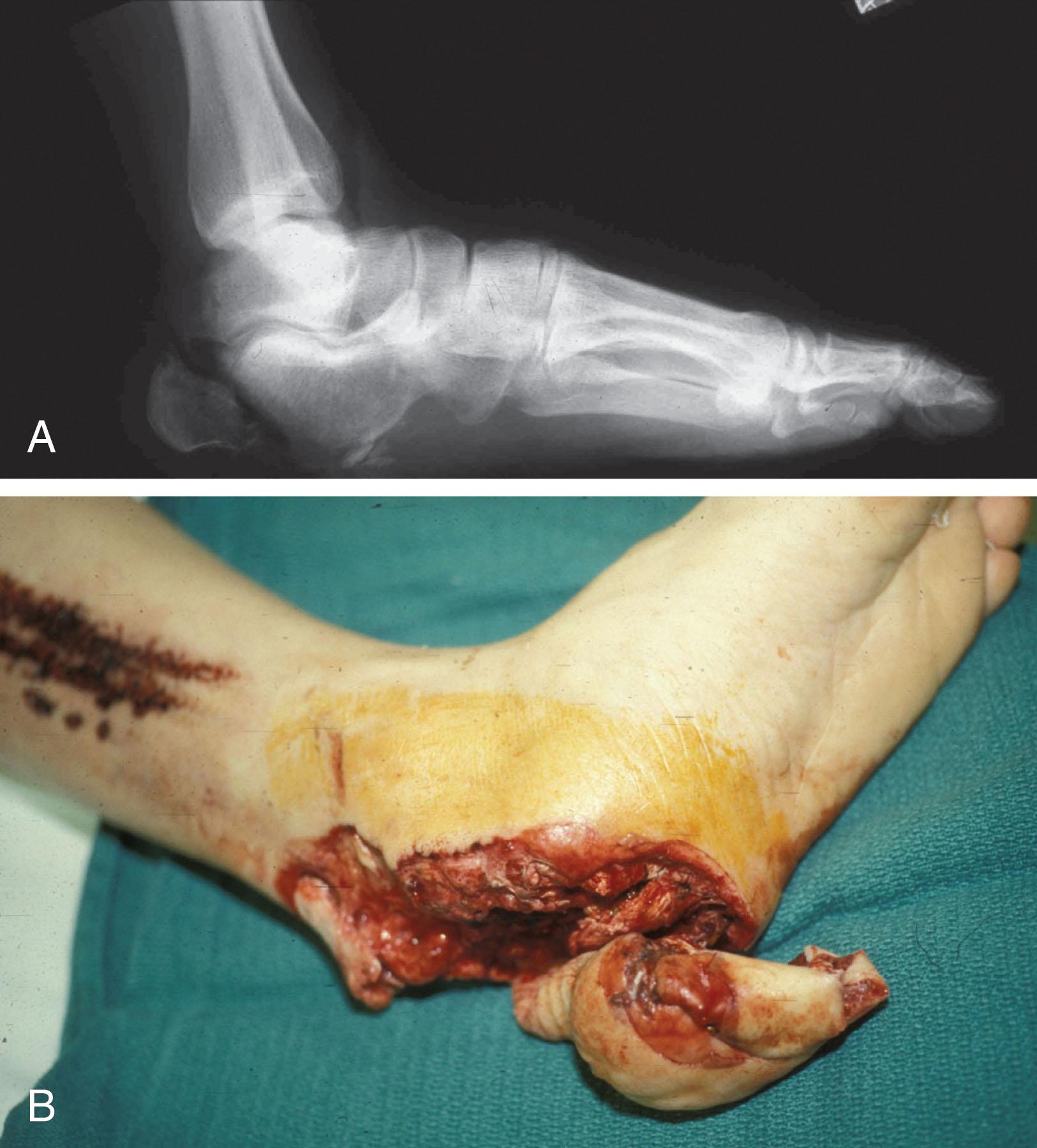 Fig. 42-6, Radiographic image (A) and photograph (B) of a type 3B open calcaneus fracture.