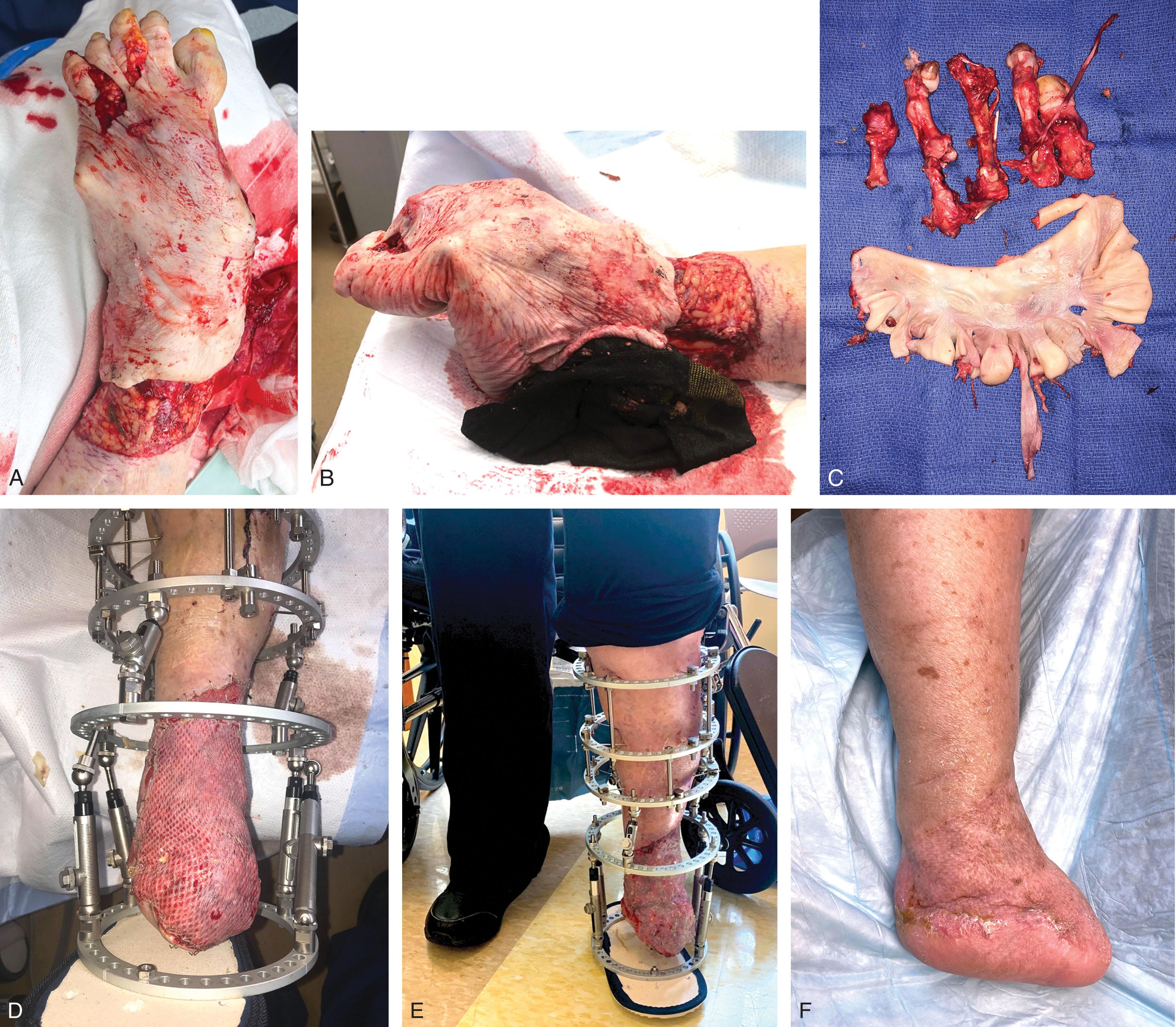 Fig. 42-7, A , Complex degloving foot injury with multiple fracture-dislocations, run over by a car. B , Lateral aspect photograph: the patient’s sock is seen forced into the wound (black object). C , Spare parts cleaned and saved in surgical refrigerator for later use. The full-thickness skin (lower structure) was used to graft the posterior heel. The plantar skin pad was salvaged, utilizing medicinal leeches to relieve venous congestion. D , The patient was placed in an external fixator for immediate ambulation, as well as to promote stability to the healing wound bed and to facilitate wound care. E , Mobility in the external fixator. F , Final appearance. The patient achieved full unrestricted ambulation with a shoe filler.