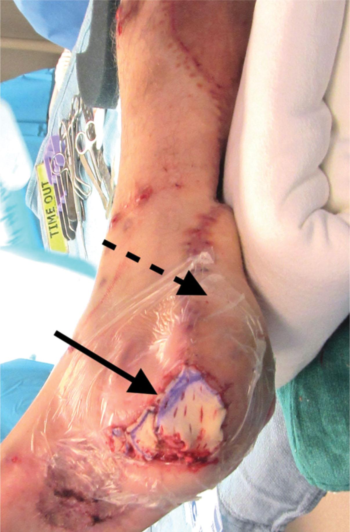 Fig. 42-8, Ancillary full thickness skin graft (FTSG) placed at residual wound distal to a reverse sural flap. An FTSG provides greater durability under pressure and shear forces than a split thickness skin graft.