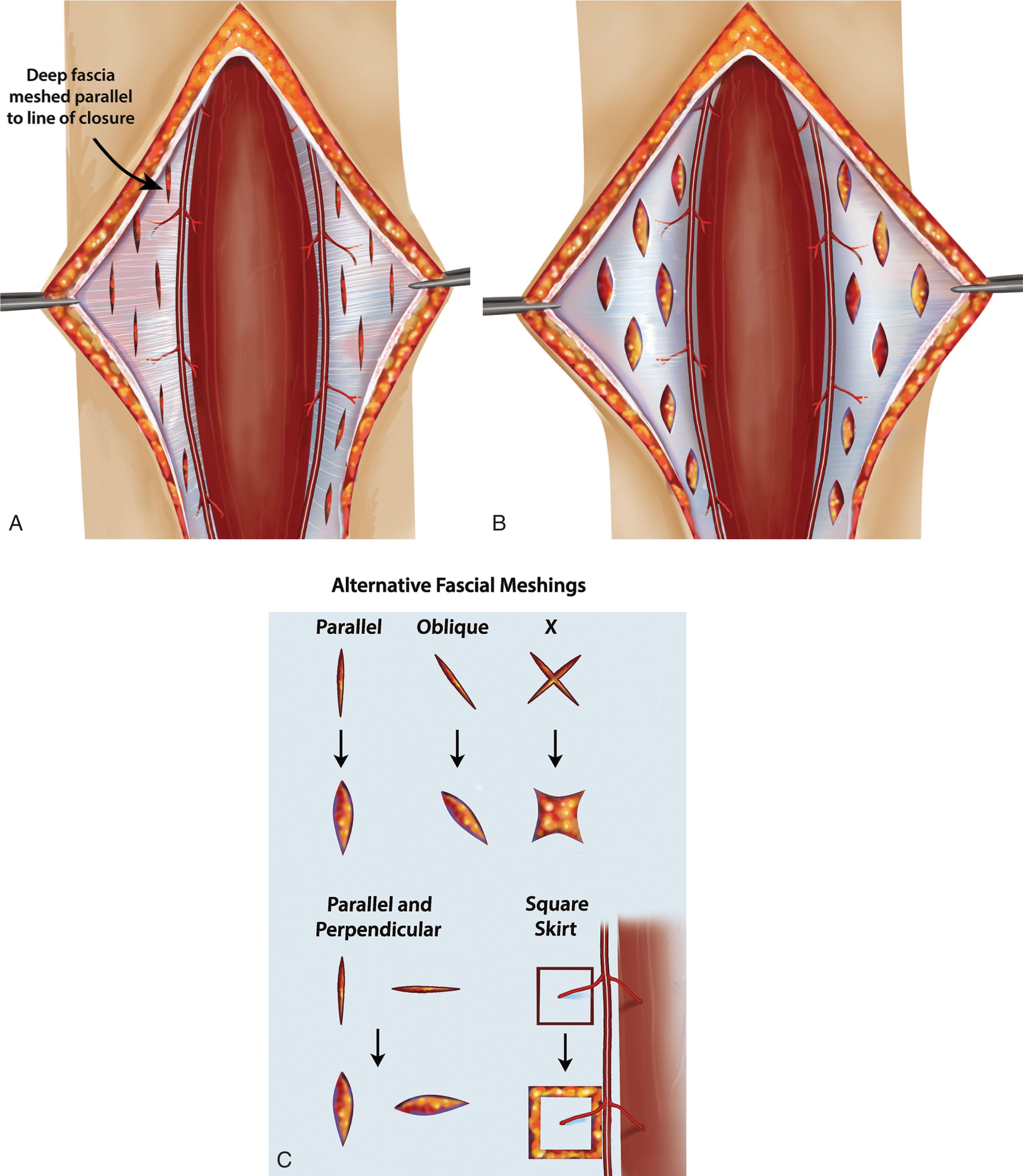 Fig. 42-9, A , Illustration of fascial meshing placed between skin perforators to expand the deep fascia, which in turn expands and improves the hysteresis characteristics of skin, ultimately allowing the entire soft tissue envelope to expand and allow closure. B , Expanded fascia after (A). C , Multiple designs may be created to allow tissue expansion along a desired axis or multiple axes.