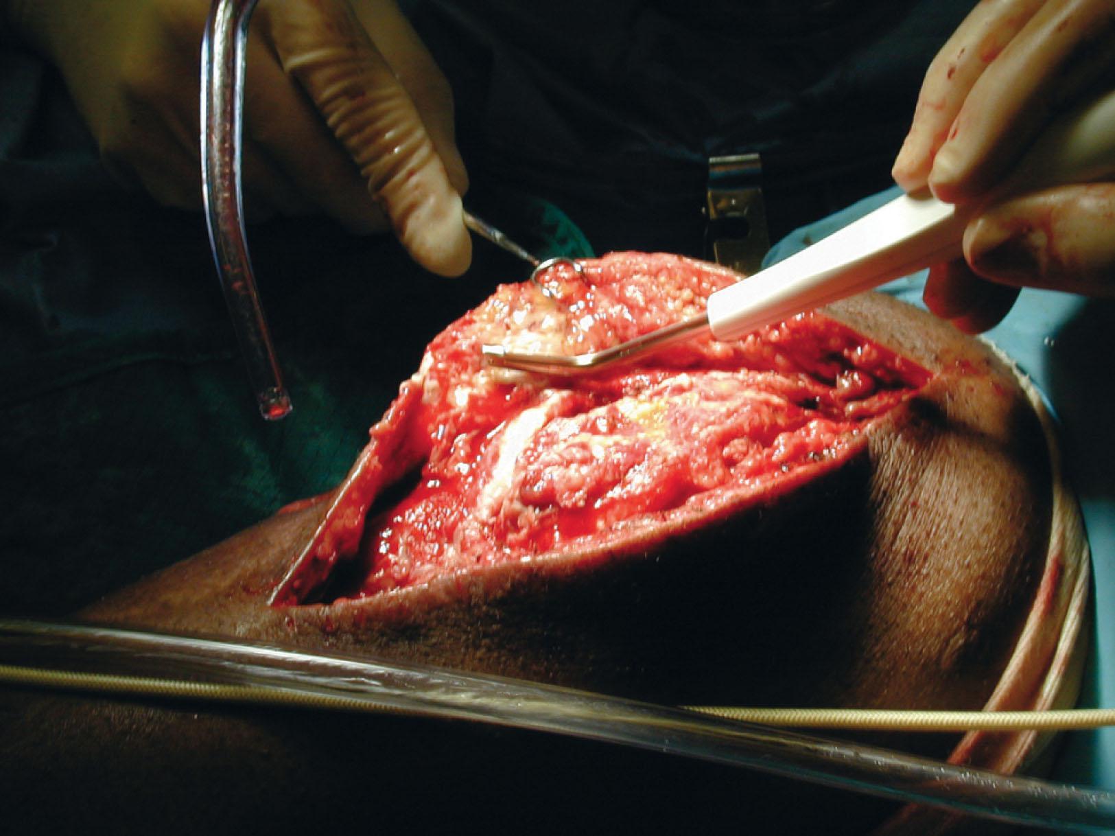 Fig. 42-10, The Versajet Hydrosurgery System in use debriding a wound.