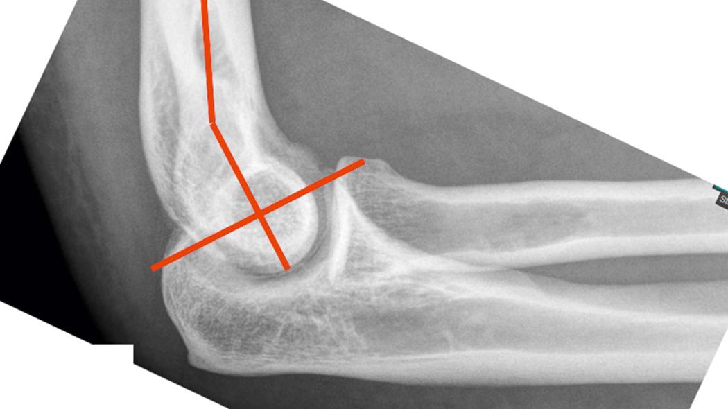 Fig. 22.1, The elbow is highly constrained; 180 degrees of the articulating surface of trochlea is in contact with proximal ulna. The distal humerus tilts approximately 30 degrees anteriorly, and semilunar notch tilts posteriorly in a reciprocal relationship.