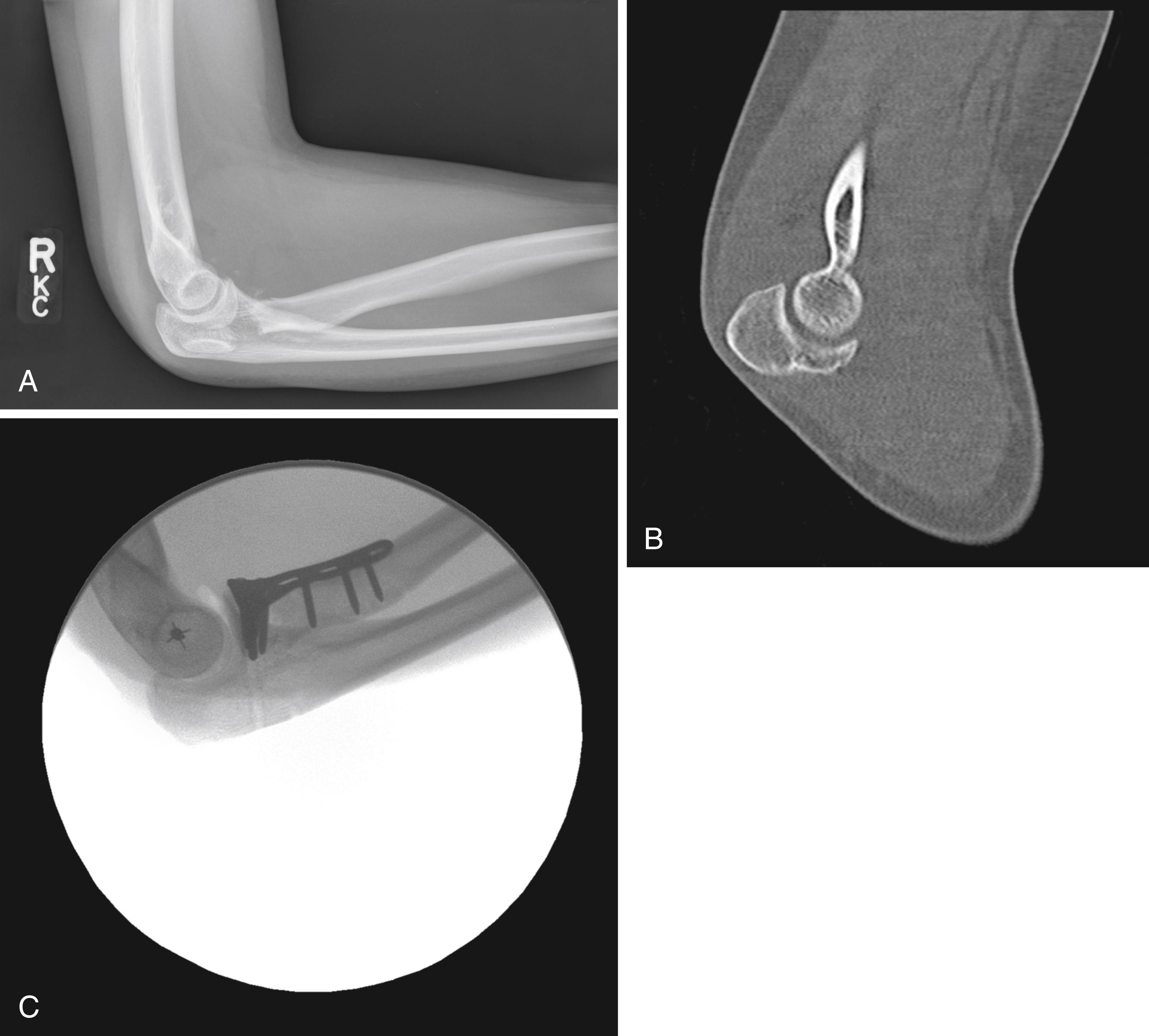 Fig. 22.3, A, Lateral radiograph in a 16-year-old girl with a radial head fracture associated with elbow dislocation. The elbow is shown here reduced, but the incarcerated radial head fragment, the malalignment of the radial neck and capitellum, and the fleck from the coronoid are clues to instability. B, Sagittal CT showing telltale coronoid fracture. C, Reconstructed elbow. The anterior instability has been repaired with transosseous suture, the radial head has been repaired, and the LCL has been repaired with a suture anchor.