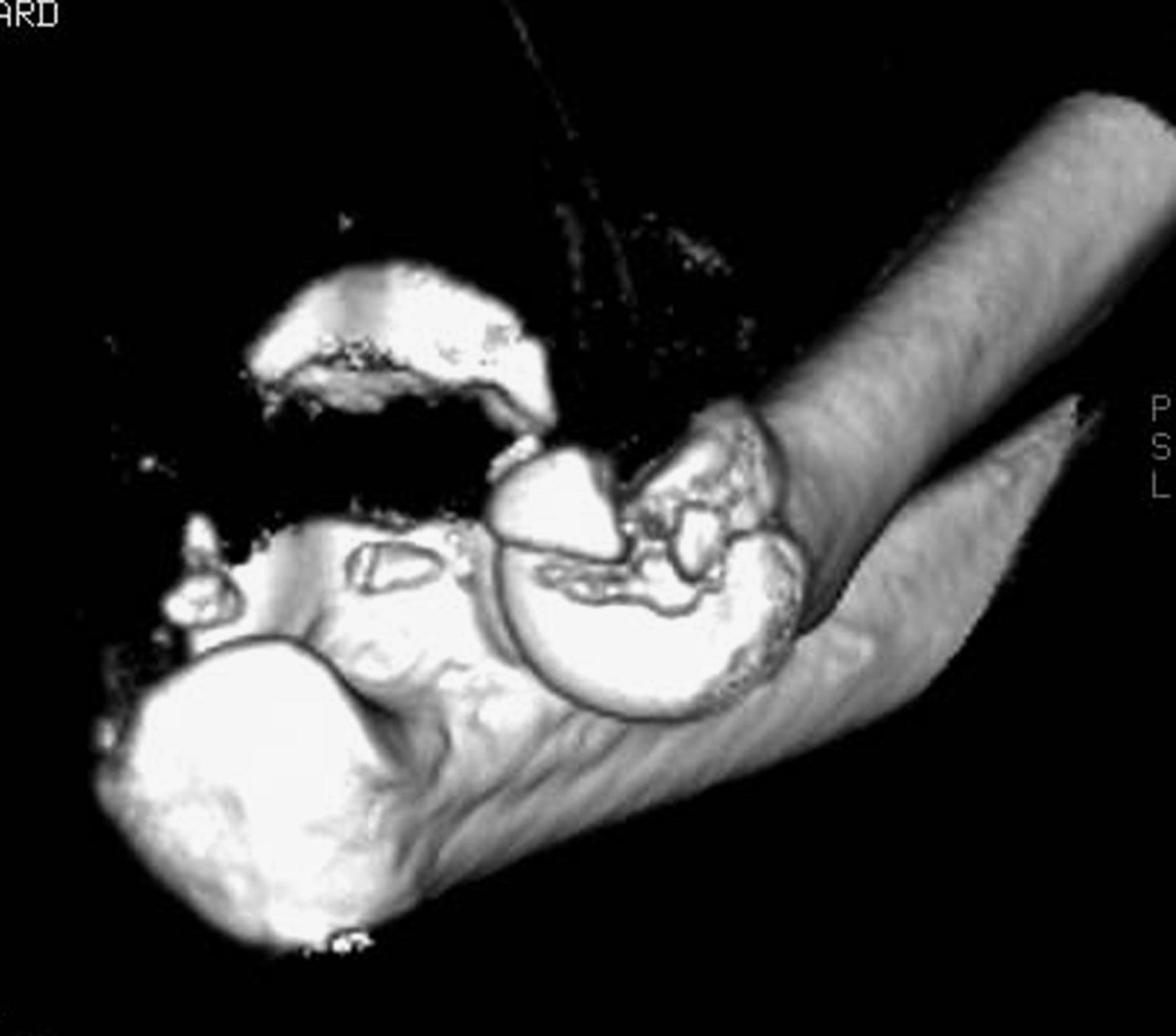 Fig. 22.4, A three-dimensional CT scan shows a coronoid fracture that is typical for a terrible triad injury: a single transverse fragment that includes the insertion of the anterior capsule. Notice that the radial head fracture involves only 40% of the articular surface but is too complex to repair.