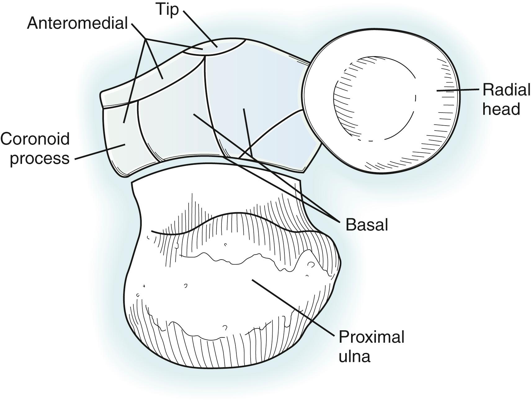 Fig. 22.5, Coronoid fracture classification as described in O’Driscoll and colleagues. 39 Tip fractures have two subtypes: Subtype I involves <2 mm of coronoid height, and subtype II involves >2 mm of coronoid height. Anteromedial fractures have three subtypes: Subtype I involves the anteromedial rim, subtype II involves the anteromedial rim and tip, and subtype III involves the anteromedial rim and sublime tubercle. Basal fractures have two subtypes: Subtype I involves the coronoid body, indicated by at least 50% of the height of the coronoid, and subtype II is associated with olecranon fractures.