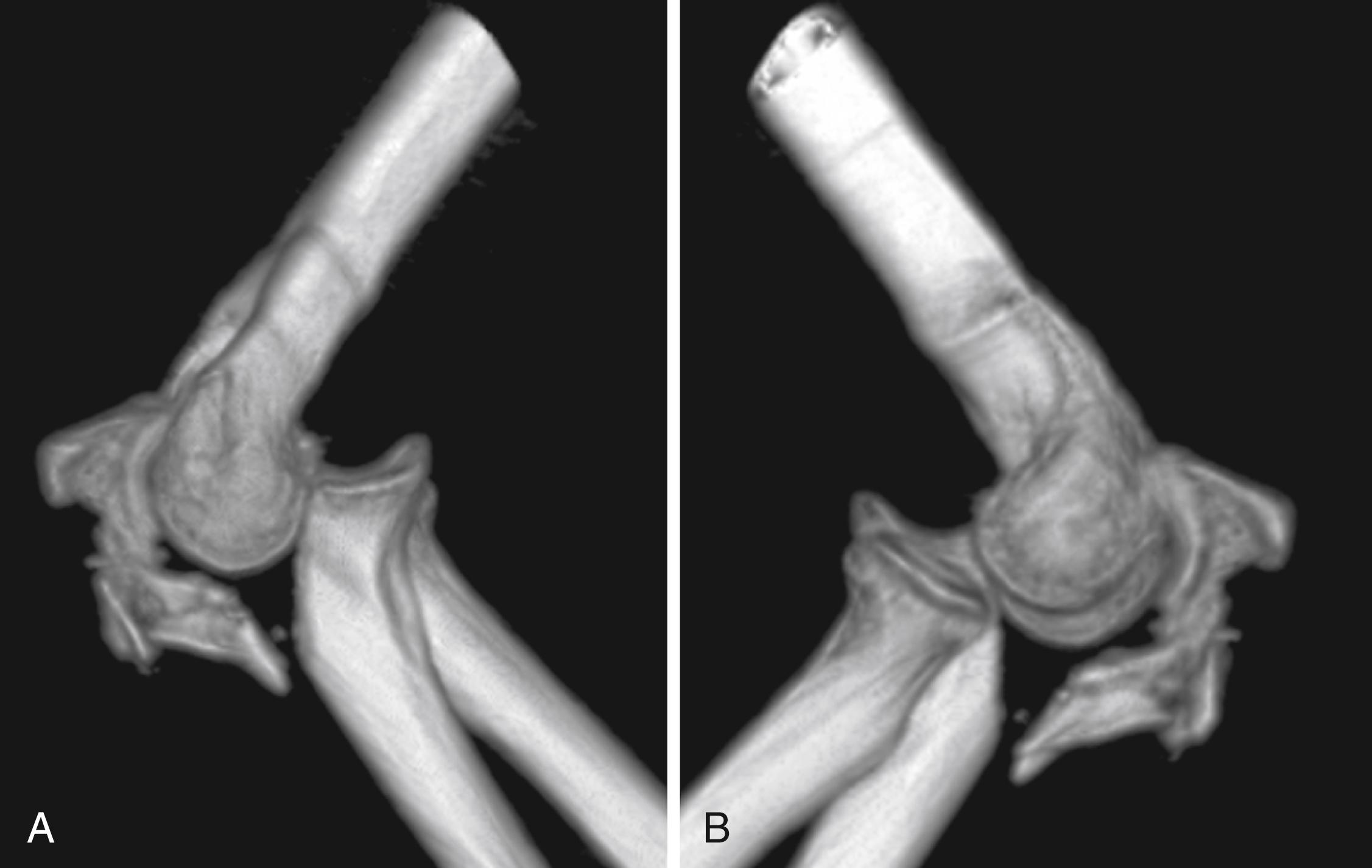 Fig. 22.6, A, Three-dimensional reconstructions of anterior transolecranon fracture-dislocation. B, Proximal radioulnar joint relationship is not disrupted in this injury.