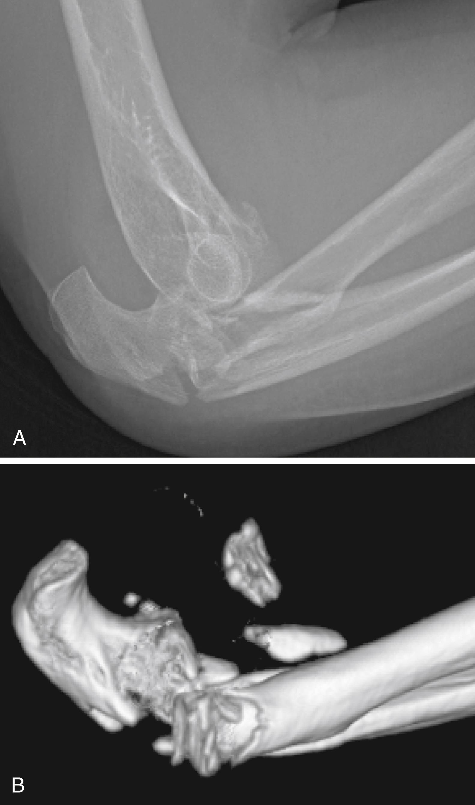 Fig. 22.7, A, Lateral radiograph of posterior Monteggia fracture-dislocation. B, Three-dimensional reconstruction of posterior Monteggia injury. Note posterior position of radial head and loss of normal proximal radioulnar relationship. Also note coronoid fracture that is typically seen with these injuries.