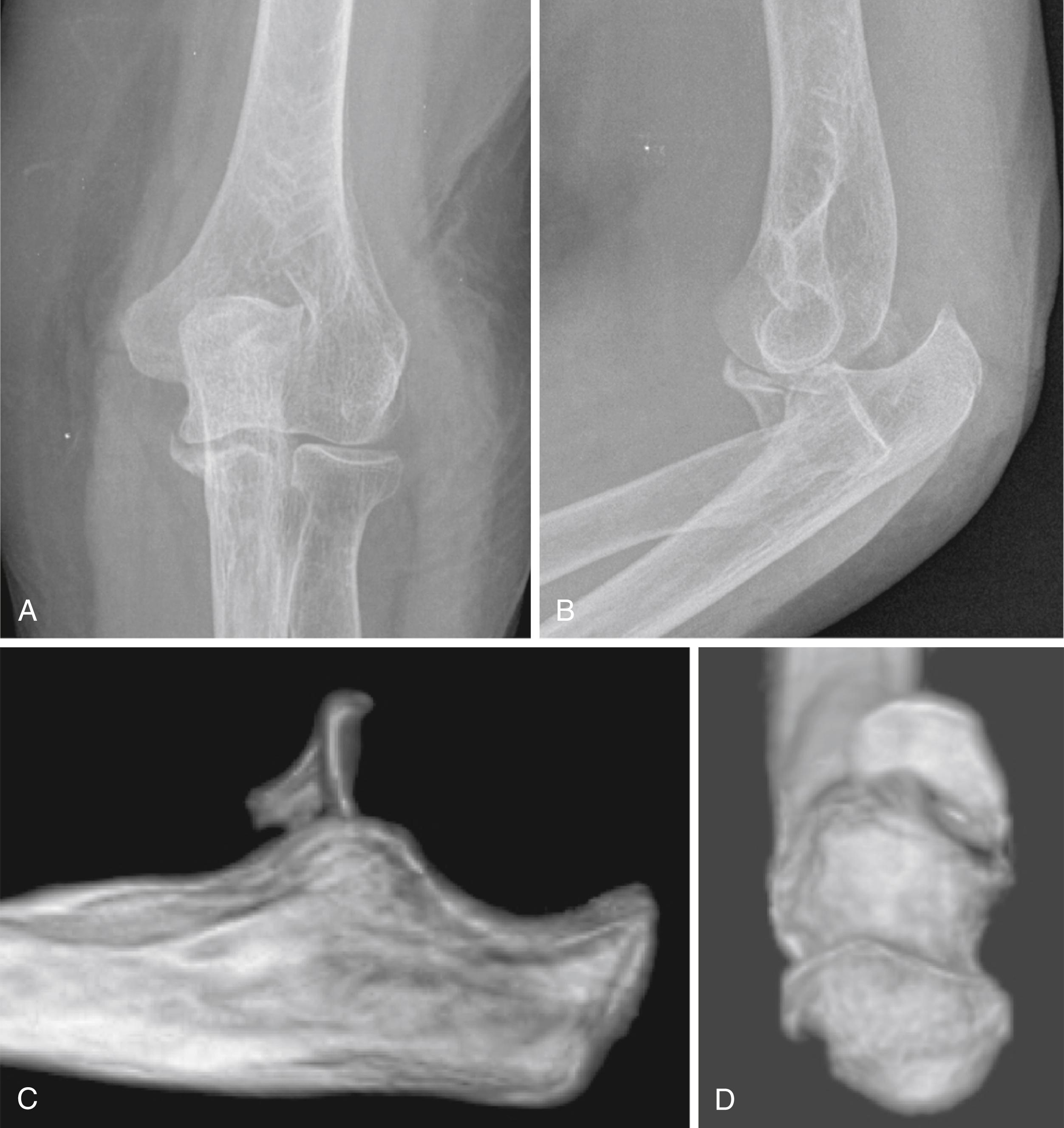 Fig. 22.8, Posteroanterior (A) and lateral (B) radiographs of acute, isolated anteromedial facet coronoid fracture. Note ulnar-humeral instability in this fracture pattern. C and D, Three-dimensional reconstructions of fracture.