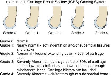 • Fig. 40.1, International Cartilage Repair Society classification system for intraoperative grading of cartilage defects applied to a capitellar lesion. Advancement to a higher grade increases with depth of the lesion.