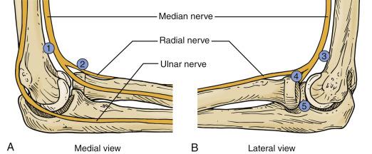 • Fig. 40.2, Line drawing of a sagittal view of the elbow, medial (A) and lateral (B) views, that demonstrate the close proximity of the periarticular neuroanatomy to the arthroscopy portals. (1 = proximal medial portal, 2 = anteromedial portal, 3 = proximal lateral portal, 4 = anterolateral portal, 5 = direct lateral portal.)