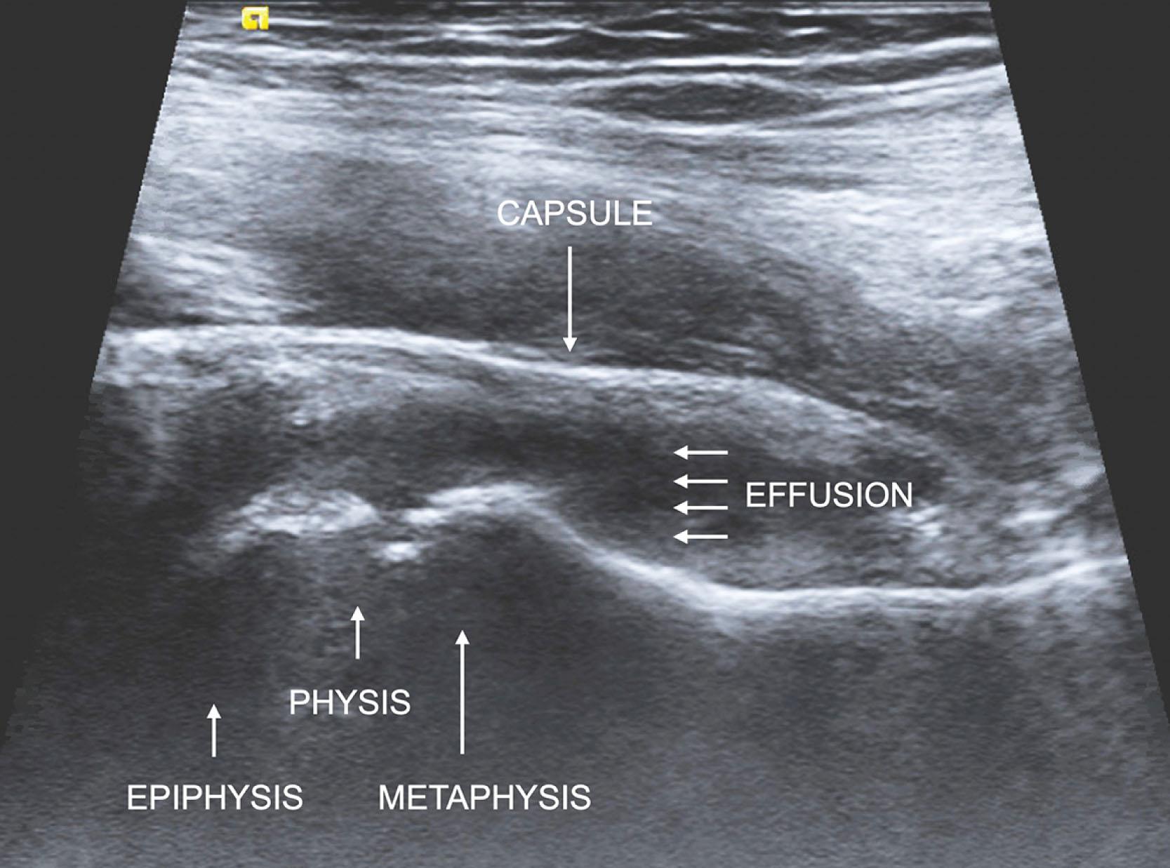 Fig. 25.1, Ultrasound of a Right Hip in a 7-Year-Old Female Demonstrating an Effusion.