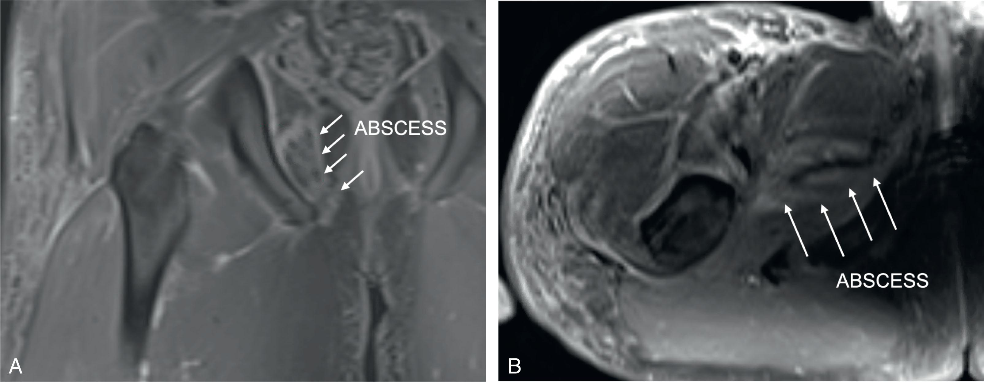 Fig. 25.2, Postcontrast coronal (A) and axial (B) T1 magnetic resonance imaging of the pelvis in a 17-year-old male initially worked up for a septic right hip, demonstrating an obturator musculature abscess requiring operative management with multiple surgeries.