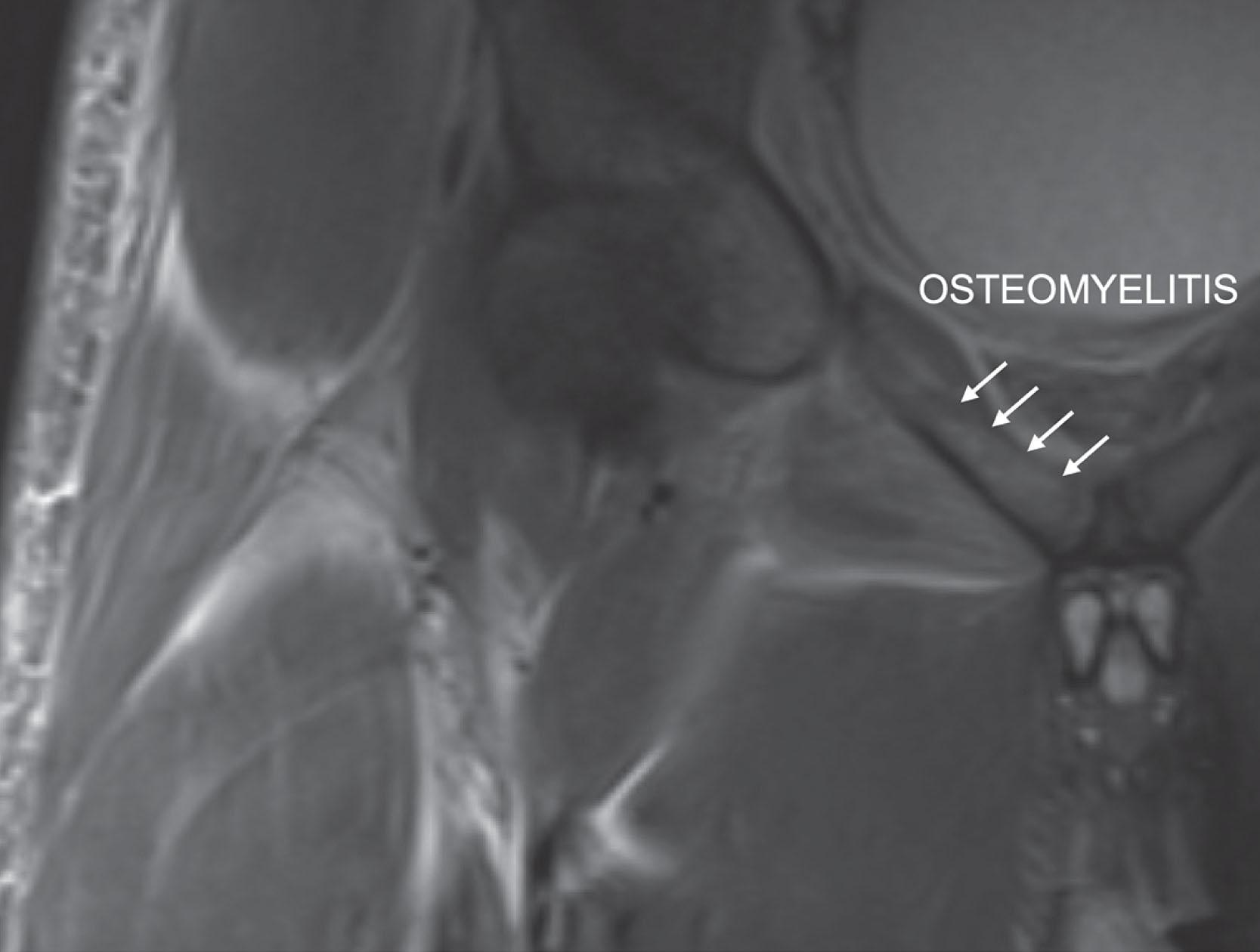 Fig. 25.3, Coronal T2 Magnetic Resonance Imaging of the Pelvis in a 17-Year-Old Male Initially Worked Up for a Septic Right Hip, Demonstrating Pubic Bone Osteomyelitis.