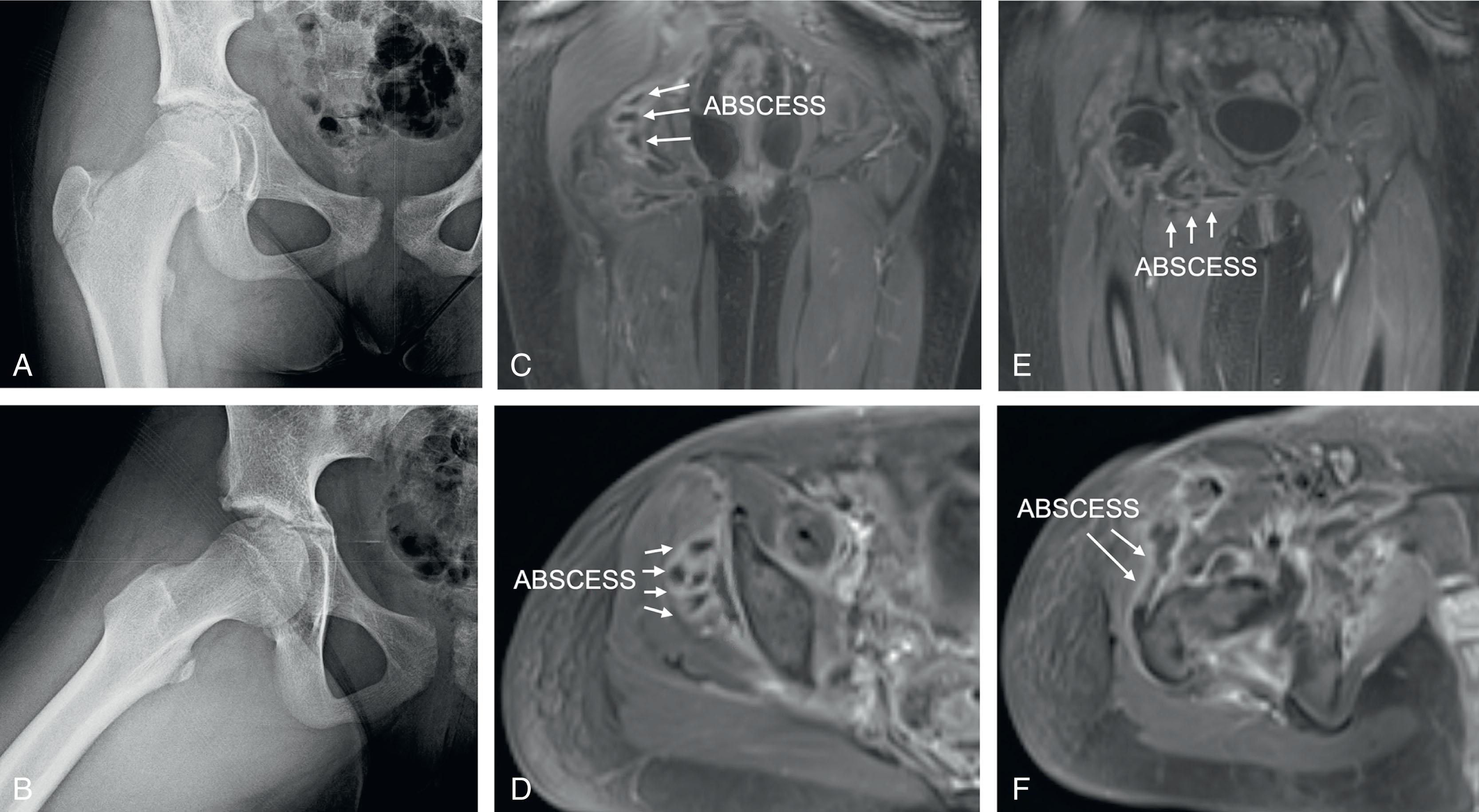 Fig. 25.4, Radiographs (A, B) and postcontrast coronal (C, E) and axial (D, F) T1 magnetic resonance imaging of the pelvis in an 11-year-old female treated for right septic arthritis of the hip with multiple associated gluteal (C, D) and obturator (E) abscesses. (F) Intra-articular extension of an abscess.