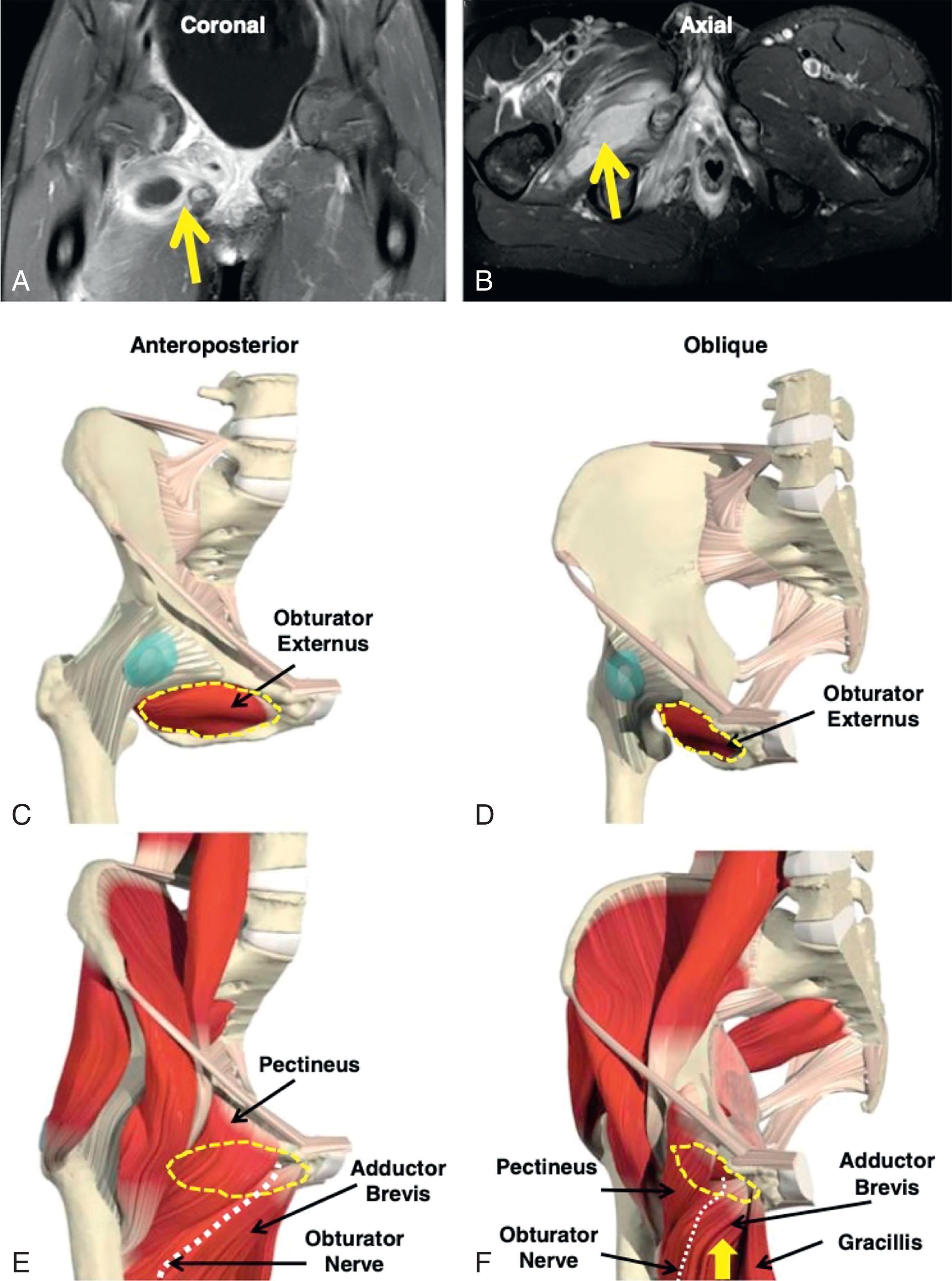 Fig. 25.5, Hip Pericapsular Pyomyositis With Abscess of the Obturator Externus. Coronal (A) and axial (B) magnetic resonance images demonstrating abscess formation in the obturator externus. (C, D) The obturator externus is a flat, oval muscle located on the outer surface of the obturator membrane (indicated by dashed yellow outline). It originates from the medial two-thirds of the obturator membrane, and the superior margin passes below the foramen, allowing the passage of the obturator neurovascular bundle. The fibers come together and form a tendon that inserts at the trochanteric fossa of the femur. It is innervated by the posterior branch of the obturator nerve and receives vascular supply from the obturator artery. (E, F) From a medial approach, the obturator externus lies on the mid to inferior portion of the obturator foramen, deep to the pectineus and adductor brevis. It can be approached either through the adductor brevis or through the adductor brevis/pectineus interval. The anterior branch of the obturator nerve lies on the superficial lateral border of the adductor brevis and is indicated by a white hashed line