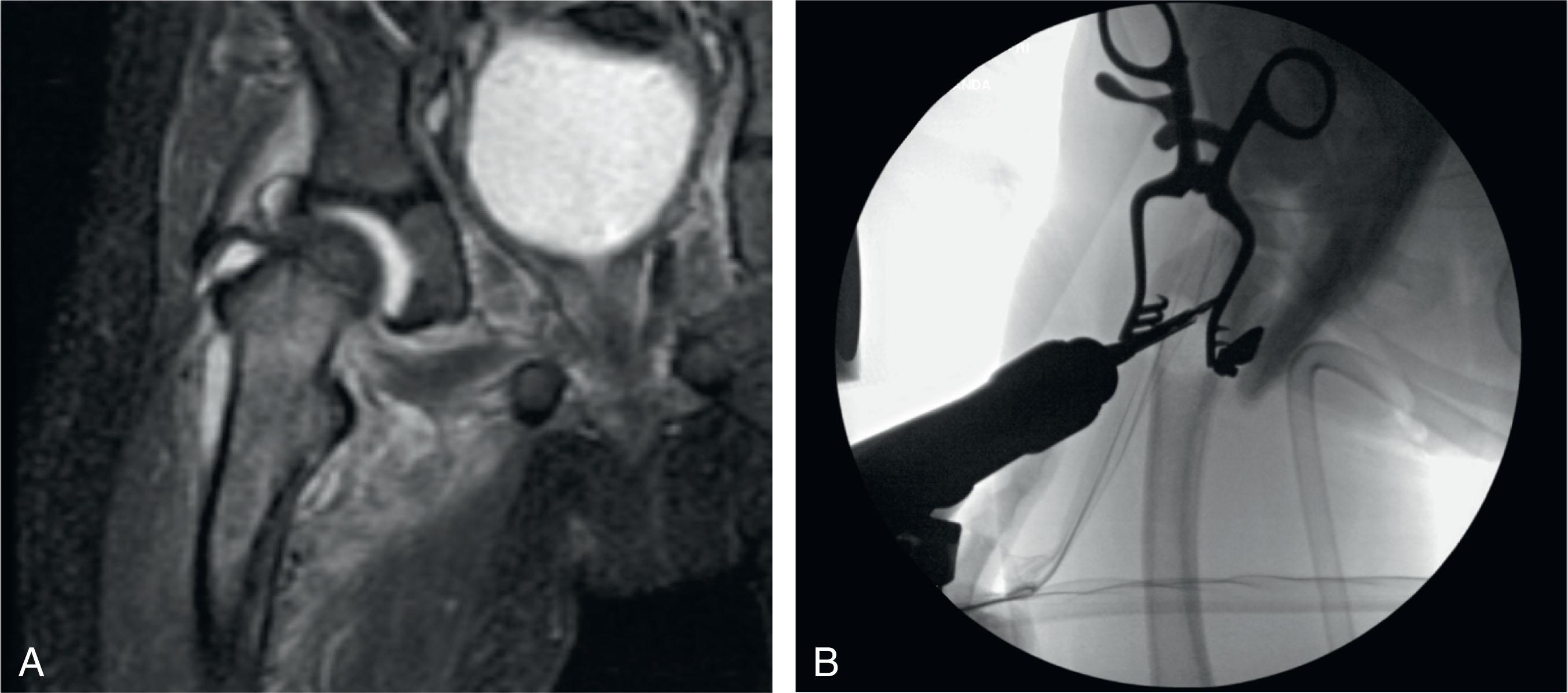 Fig. 25.6, Coronal T2-weighted magnetic resonance imaging (A) and intraoperative fluoroscopy (B) imaging demonstrating drilling of concomitant proximal femur metaphyseal osteomyelitis at time of septic hip joint irrigation and debridement in a 2-year-old.