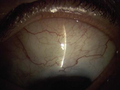 Figure 93-2, Thick, diffuse bleb created with multiple MMC sponges (IOP 11 mmHg).