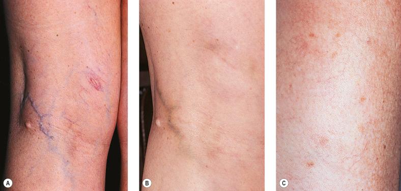 Figure 8.1, Linear pigmentation along the course of a treated blood vessel. A, Before treatment. B, Eight weeks after treatment with polidocanol 0.5%. C, Punctate pigmentation 8 weeks after treatment with Sclerodex. Rights were not granted to include this figure in electronic media. Please refer to the printed book.