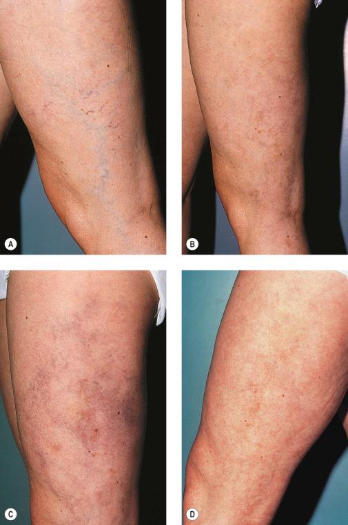 Figure 8.12, Typical telangiectatic matting (TM) in a 36-year-old woman. A, Left lateral thigh before sclerotherapy treatment. B, Three months after treatment of reticular veins with polidocanol (POL) 0.75%. C, Six weeks after treatment of telangiectatic veins with POL 0.5%; note development of extensive TM. D, Six weeks later. Note complete resolution of TM without treatment. Rights were not granted to include this figure in electronic media. Please refer to the printed book.