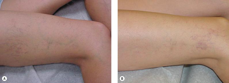 Figure 8.14, A, Before treatment. Note reticular vein feeding into telangiectasia on the superior lateral thigh. B, Six weeks after sclerotherapy treatment. Note resolution of superior lateral thigh telangiectasia with appearance of ‘new’ telangiectasia distal to point of injection.