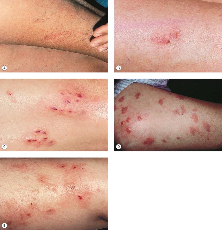 Figure 8.16, Urtication immediately after sclerotherapy with hypertonic saline 23.4% (A), sodium tetradecyl sulfate 0.1% (B), polidocanol 0.5% (C), chromated glycerin (D) and Sclerodex (E).